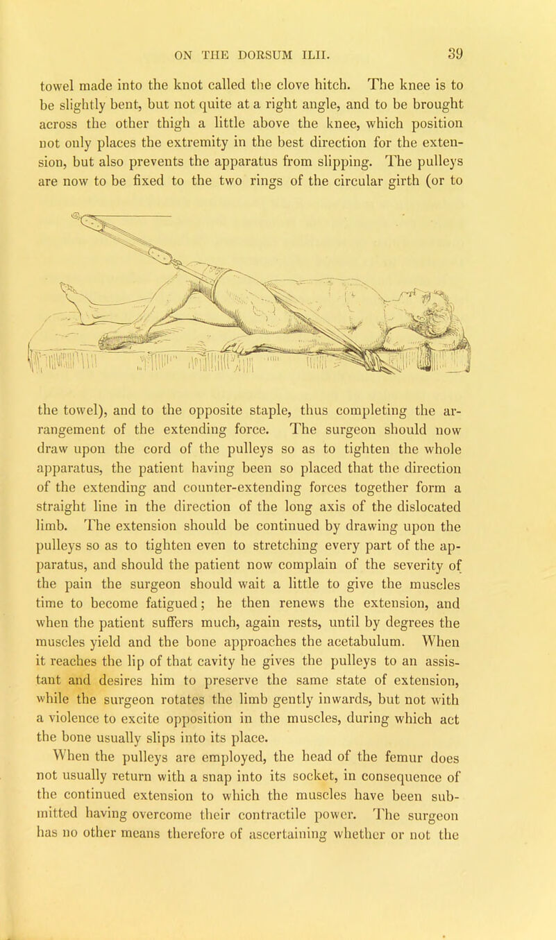 towel made into the knot called the clove hitch. The knee is to be slightly bent, but not quite at a right angle, and to be brought across the other thigh a little above the knee, which position not only places the extremity in the best direction for the exten- sion, but also prevents the apparatus from slipping. The pulleys are now to be fixed to the two rings of the circular girth (or to I'lllll/ILllll/l the towel), and to the opposite staple, thus completing the ar- rangement of the extending force. The surgeon should now draw upon the cord of the pulleys so as to tighten the whole apparatus, the patient having been so placed that the direction of the extending and counter-extending forces together form a straight line in the direction of the long axis of the dislocated limb. The extension should he continued by drawing upon the pulleys so as to tighten even to stretching every part of the ap- paratus, and should the patient now complain of the severity of the pain the surgeon should wait a little to give the muscles time to become fatigued; he then renews the extension, and w'hen the patient suffers much, again rests, until by degrees the muscles yield and the bone approaches the acetabulum. When it reaches the lip of that cavity he gives the pulleys to an assis- tant and desires him to preserve the same state of extension, while the surgeon rotates the limb gently inwards, but not with a violence to excite opposition in the muscles, during which act the bone usually slips into its place. When the pulleys are employed, the head of the femur does not usually return with a snap into its socket, in consequence of the continued extension to which the muscles have been sub- mitted having overcome their contractile power. The surgeon has no other means therefore of ascertaining whether or not the