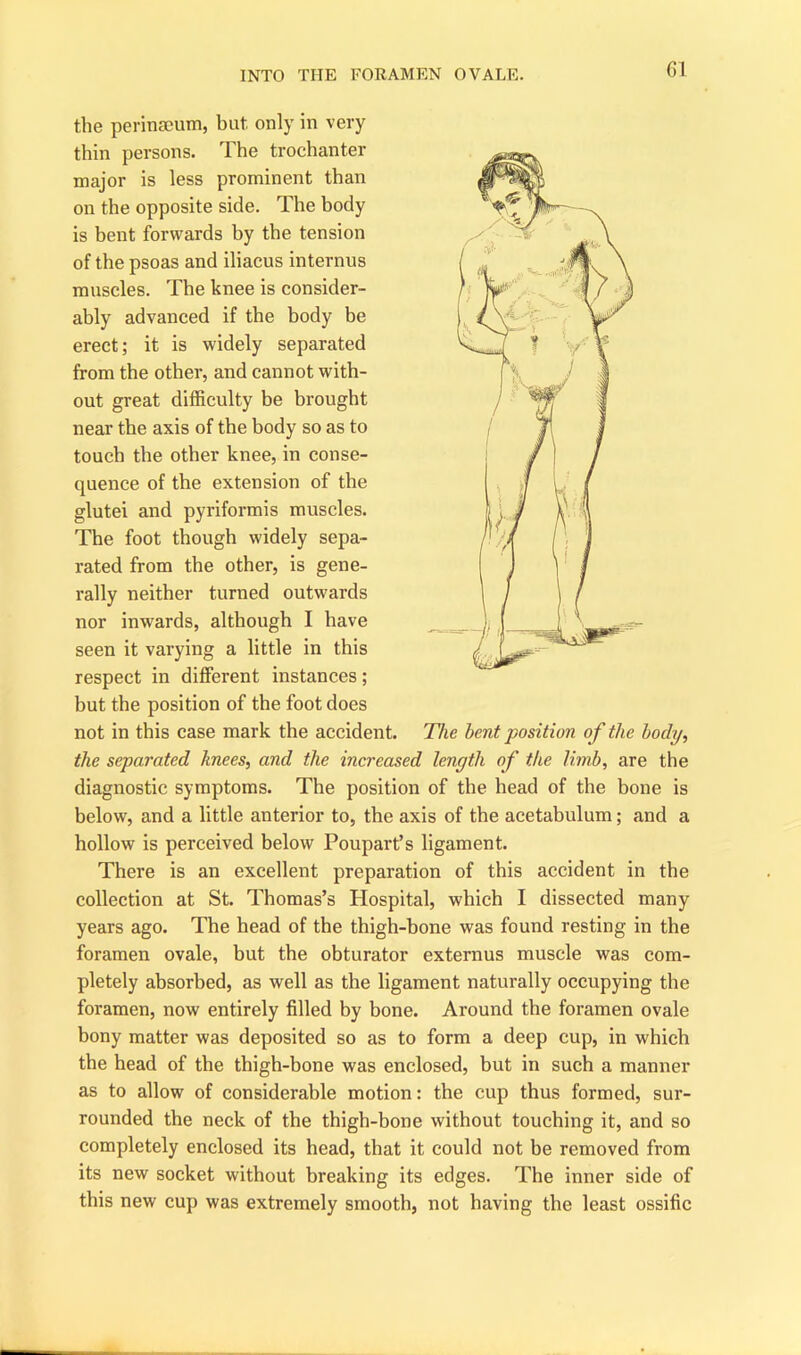 the perinseum, but. only in very thin persons. The trochanter major is less prominent than on the opposite side. The body is bent forwards by the tension of the psoas and iliacus internus muscles. The knee is consider- ably advanced if the body be erect; it is widely separated from the other, and cannot with- out great difficulty be brought near the axis of the body so as to touch the other knee, in conse- quence of the extension of the glutei and pyriformis muscles. The foot though widely sepa- rated from the other, is gene- rally neither turned outwards nor inwards, although I have seen it varying a little in this respect in different instances; but the position of the foot does not in this case mark the accident. The bent position of the body, the separated knees, and the increased length of the limb, are the diagnostic symptoms. The position of the head of the bone is below, and a little anterior to, the axis of the acetabulum; and a hollow is perceived below Poupart’s ligament. There is an excellent preparation of this accident in the collection at St. Thomas’s Hospital, which I dissected many years ago. The head of the thigh-bone was found resting in the foramen ovale, but the obturator externus muscle was com- pletely absorbed, as well as the ligament naturally occupying the foramen, now entirely filled by bone. Around the foramen ovale bony matter was deposited so as to form a deep cup, in which the head of the thigh-bone was enclosed, but in such a manner as to allow of considerable motion: the cup thus formed, sur- rounded the neck of the thigh-bone without touching it, and so completely enclosed its head, that it could not be removed from its new socket without breaking its edges. The inner side of this new cup was extremely smooth, not having the least ossific