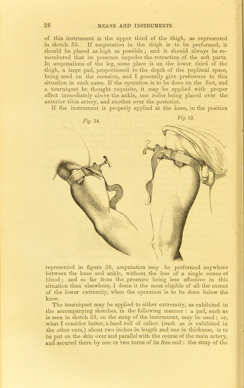 of this instrument is the upper third of the thigh, as represented in sketch 35. If amputation in the thigh is to be performed, it should be placed as high as possible ; and it should always be re- membered that its presence impedes the retraction of the soft parts. In amputations of the leg, some place it on the lower third of the thigh, a large pad, proportioned to the depth of the popliteal space, being used on the occasion, and I generally give preference to this situation in such cases. If the operation is to be done on the foot, and a tourniquet be thought requisite, it may be applied with proper effect immediately above the ankle, one roller being placed over the anterior tibia artery, and another over the posterior. If the instrument is properly applied at the knee, in the position rejjresented in figure 3G, amputation may be performed anywhere between the knee and ankle, without the loss of a single ounce of blood; and so far from the pressure being less effective in this situation than elsewhere, I deem it the most eligible of all the extent of the lower extremity, when the operation is to be done below the knee. The tommiquet may be applied to either extremity, as exhibited in the accompan3dng sketches, in the following manner : a pad, such as is seen in sketch 33, on the strap of the instrument, may be used ; or, what I consider better, a hard roll of calico (such as is exhibited in the other cuts,) about two inches in length and one in thickness, is to be put on the skin over and parallel with the course of the main artery, and secured there by one or two turns of its free end : the strap of the