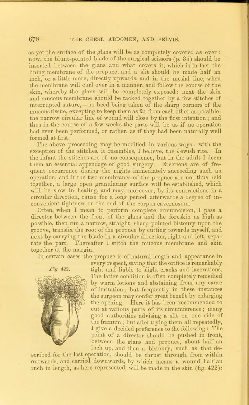 as yet the surface of the glans will be as completely covered as ever : now, the blunt-pointed blade of the surgical scissors (p. 35) should be inserted between the glans and what covers it, which is in fact the lining membrane of the prepuce, and a slit should be made half an inch, or a little more, directly upwards, and in the mesial line, when the membrane will curl over in a manner, and follow the course of the skin, whereby the glans will be completely exposed: next the skin and mucous membrane should be tacked together by a few stitches of interrupted suture,—no heed being taken of the sharp corners of the mucous tissue, excepting to keep them as far from each other as possible: the narrow circular line of wound will close by the first intention; and thus in the course of a few weeks the parts will be as if no operation had ever been performed, or rather, as if they had been naturally well formed at first. The above proceeding may be modified in various ways: with the exception of the stitches, it resembles, I believe, the Jewish rite. In the infant the stitches are of no consequence, but in the adult I deem them an essential appendage of good surgery. Erections are of fre- quent occm-rence during the nights immediately succeeding such an operation, and if the two membranes of the prepixce are not thus held together, a large open granulating surface will be established, which will be slow in healing, and may, moreover, by its contractions in a circular direction, cause for a long period afterwards a degree of in- convenient tightness on the end of the corpus cavernosum. Often, when I mean to perform complete circumcision, I pass a director between the front of the glans and the foreskin as high as possible, then run a narrow, straight, sharp-pointed bistoury upon the groove, transfix the root of the prepuce by cutting towai’ds myself, and next by carrying the blade in a circular direction, right and left, sepa- rate the part. Thereafter I stitch the mucous membrane and skin together at the margin. In certain cases the prepuce is of natural length and appearance in every respect, saving that the orifice is remarkably tight and liable to slight cracks and lacerations. The latter condition is often completely remedied by warm lotions and abstaining from any cause of irritation; but frequently in these instances the surgeon may confer great benefit by enlarging the opening. Here it has been recommended to cut at various parts of its circumference; many good authorities advising a slit on one side of thefrasnum; but after trying them all repeatedly, I give a decided jxreference to the following: The point of a director should be pushed in front, between the glans and prepuce, about half an inch iqx, and tlien a bistoury, such as that de- scribed for the last operation, should be thrust through, from within outwards, and carried downwards, by wliich means a wound half an inch in length, as here represented, will be made in the skin (fig. 422): Fig 422.