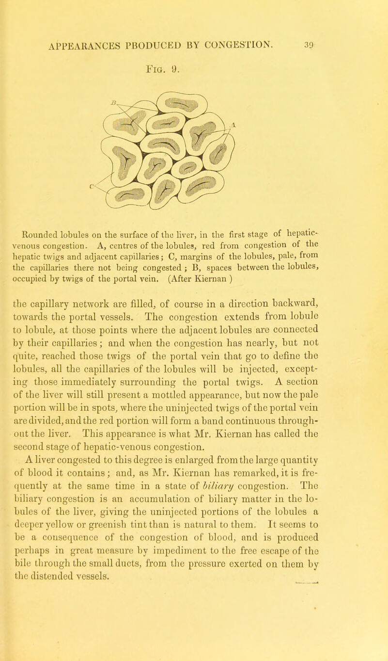 Fig. 9. Rounded lobules on the surface of the liver, in the first stage of hepatic- venous congestion. A, centres of the lobules, red from congestion of the hepatic twigs and adjacent capillaries; C, margins of the lobules, pale, from the capillaries there not being congested ; B, spaces between the lobules, occupied by twigs of the portal vein. (After Kiernan ) die capillary network are filled, of course in a direction backward, towards the portal vessels. The congestion extends from lobule to lobule, at those points where the adjacent lobules are connected by their capillaries; and when the congestion has nearly, but not quite, reached those twigs of the portal vein that go to define the lobules, all the capillaries of the lobules will be injected, except- ing those immediately surrounding the portal twigs. A section of the liver will still present a mottled appearance, but now the pale portion will be in spots, where the uninjected twigs of the portal vein are divided, and the red portion will form a band continuous through- out the liver. This appearance is what Mr. Kiernan has called the second stage of hepatic-venous congestion. A liver congested to this degree is enlarged from the large quantity of blood it contains; and, as Mr. Kiernan has remarked, it is fre- quently at the same time in a state of biliary congestion. The biliary congestion is an accumulation of biliary matter in the lo- bules of the liver, giving the uninjected portions of the lobules a deeper yellow or greenish tint than is natural to them. It seems to be a consequence of the congestion of blood, and is produced perhaps in great measure by impediment to the free escape of the bile through the small ducts, from the pressure exerted on them by the distended vessels.