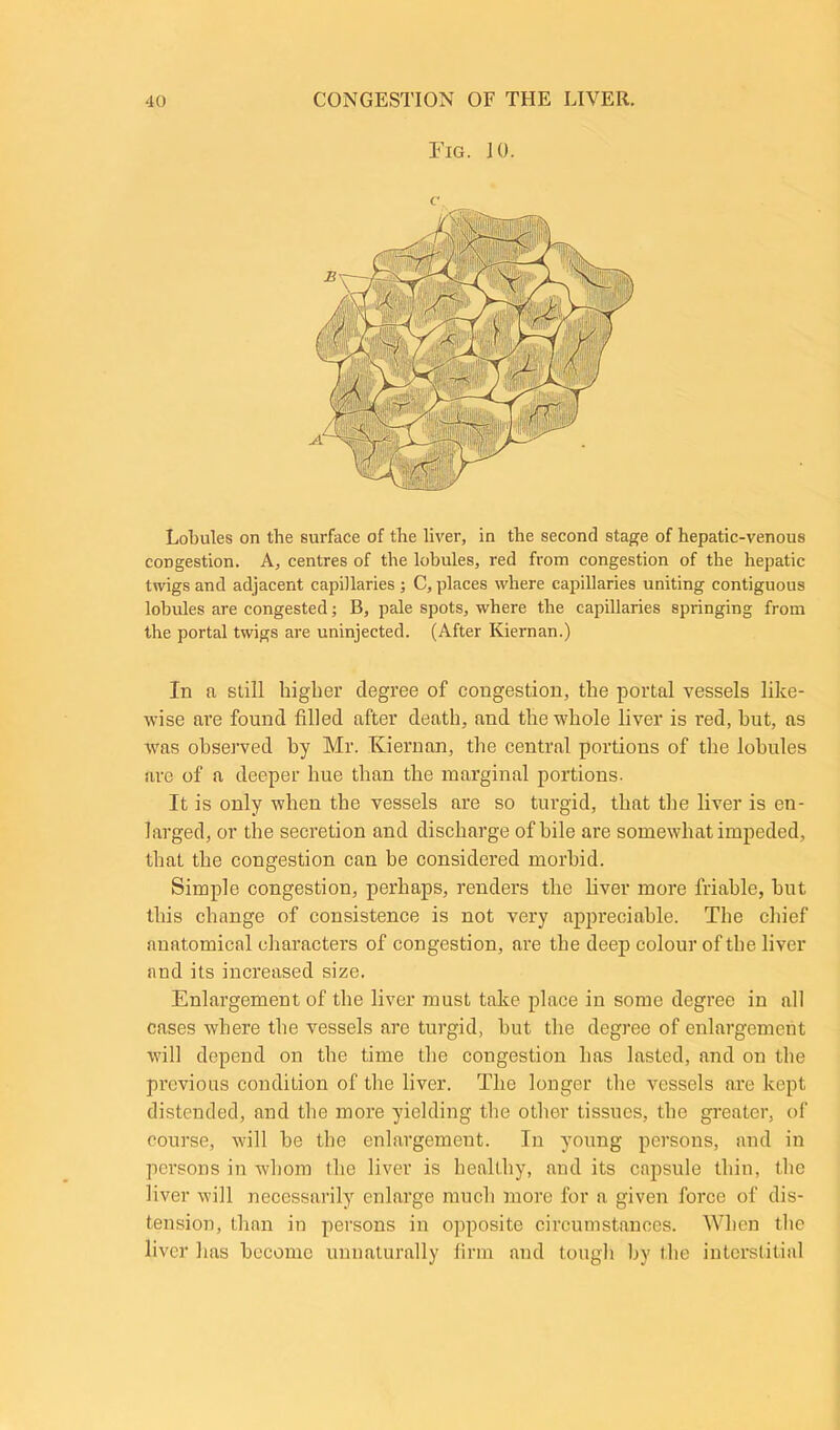 Fig. 10. c. Lobules on the surface of the liver, in the second stage of hepatic-venous congestion. A, centres of the lobules, red from congestion of the hepatic twigs and adjacent capillaries ; C, places where capillaries uniting contiguous lobules are congested; B, pale spots, where the capillaries springing from the portal twigs are uninjected. (After Kiernan.) In a still higher degree of congestion, the portal vessels like- wise are found filled after death, and the whole liver is red, hut, as was observed by Mr. Kiernan, the central portions of the lohules are of a deeper hue than the marginal portions. It is only when the vessels are so turgid, that the liver is en- larged, or the secretion and discharge of hile are somewhat impeded, that the congestion can be considered morbid. Simple congestion, perhaps, renders the liver more friable, but this change of consistence is not very appreciable. The chief anatomical characters of congestion, are the deep colour of the liver and its increased size. Enlargement of the liver must take place in some degree in all cases where the vessels are turgid, but the degree of enlargement will depend on the time the congestion has lasted, and on the previous condition of the liver. The longer the vessels are kept distended, and the more yielding the other tissues, the greater, of course, will be the enlargement. In young persons, and in persons in whom the liver is healthy, and its capsule thin, the liver will necessarily enlarge much more for a given force of dis- tension, than in persons in opposite circumstances. When the liver has become unnaturally firm and tough by the interstitial