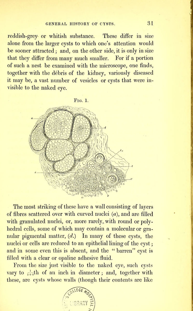 reddish-grey- or whitish substance. These differ in size alone from the larger cysts to which one’s attention would be sooner attracted; and, on the other side, it is only in size that they differ from many much smaller. For if a portion of such a nest be examined with the microscope, one finds, together with the debris of the kidney, variously diseased it may be, a vast number of vesicles or cysts that were in- visible to the naked eye. Fig. 1. 1 I The most striking of these have a wall consisting of layers of fibres scattered over with curved nuclei (a), and are filled with granulated nuclei, or, more rarely, with round or poly- hedral cells, some of which may contain a molecular or gra- nular pigmental matter, (f/.) In many of these cysts, the nuclei or cells are reduced to an epithelial lining of the cyst; and in some even this is absent, and the “ barren” cyst is filled with a clear or opaline adhesive fluid. From the size just visible to the naked eye, such cysts vary to 5 ~^th of an inch in diameter; and, together with these, are cysts whose walls (though their contents are like