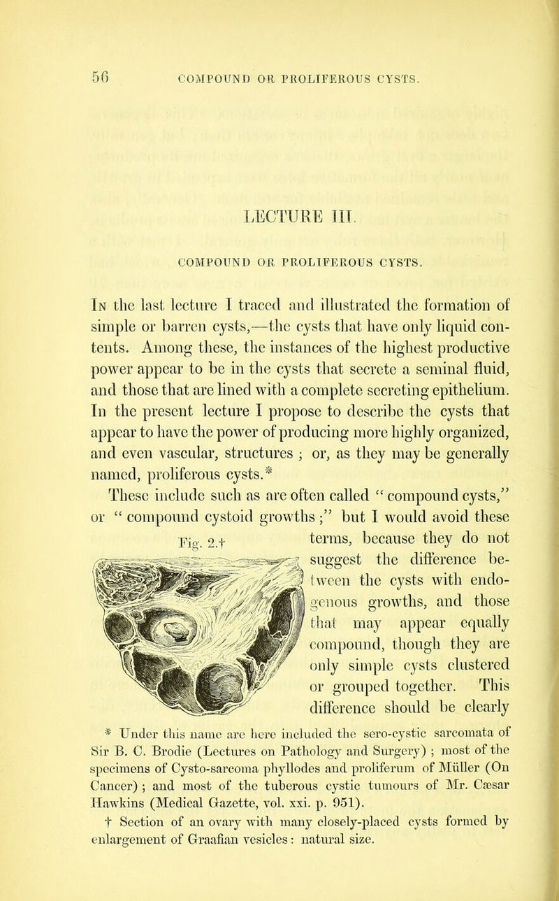 LECTURE m COMPOUND OR PROLIFEROUS CYSTS. In the last lecture I traced and illustrated the forraation of simple or barren cysts,—the cysts that have only liquid con- tents. Among these, the instances of the highest productive power ajipear to be in the cysts that secrete a seminal fluid, and those that are lined with a complete secreting epithelium. In the present lecture I propose to describe the cysts that appear to have the power of producing more highly organized, and even vascular, structures j or, as they may be generally named, proliferous cysts. These include such as are often called “ compound cysts,” or “ compound cystoid growthsbut I would avoid these * Under this name arc liere included the sero-cystic sarcomata of Sir B. C. Brodie (Lectures on Pathology and Surgery) ; most of the specimens of Cysto-sarcoma phyllodes and proliferum of Muller (On Cancer) ; and most of the tuberous cystic tumours of Mr. Cscsar Hawkins (Medical G-azette, vol. xxi. p. 951). t Section of an ovary with many closely-placed cysts formed by enlargement of Graafian vesicles: natural size. terms, because they do not suggest the diflerence be- tween the cysts with endo- genous growths, and those that may appear equally compound, though they are only simple cysts clustered or grouped together. This difference should be clearly