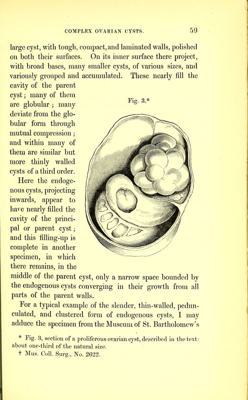large cyst, with tough, compact,and laminated walls, polished on both their surfaces. On its inner surface there project, with broad bases, many smaller cysts, of various sizes, and variously grouped and accumulated. These nearly fill the cavity of the parent Fig. 3.* cyst; many of them are globular ; many deviate from the glo- bular form through mutual compression; and within many of them are similar but more thinly walled cysts of a third order. Here the endoge- nous cysts, projecting inwards, appear to ha\ e nearly filled the cavity of the princi- pal or parent cyst; and this filling-u]i is complete in another specimen, in which there remains, in the middle of the parent cyst, only a narrow space bounded by the endogenous cysts converging in their growth from all parts of the parent walls. For a typical example of the slender, thin-walled, pedun- culated, and clustered form of endogenous cysts, I may adduce the specimen from the Museum of St. BartholomeAv’s * Fig. 3, section of a proliferous ovarian cyst, described in tbe text; about one-third of the natural size, t Mns. Coll. Surg., No. 2622.