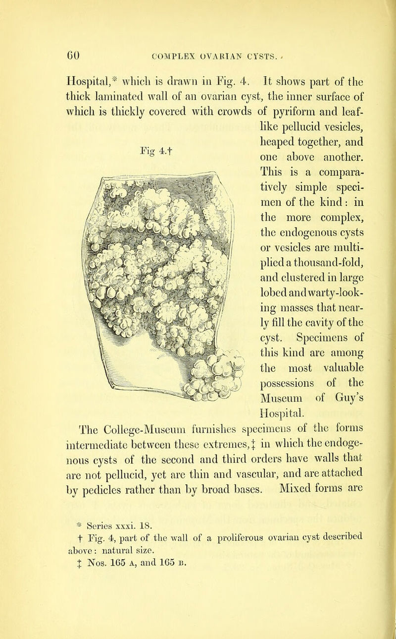 Hospital,* which is drawn in Fig. 4. It shows part of the thick laminated wall of an ovarian cyst, the inner surface of which is thickly covered with crowds of pyriform and leaf- like pellucid vesicles, heaped together, and one above another. This is a compara- tively simple speci- men of the kind : in the more complex, the endogenous cysts or vesicles are multi- plied a thousand-fold, and clustered in large lobed and warty-look- ing masses that near- ly fill the cavity of the cyst. Specimens of this kind are among the most valuable possessions of the Museum of Guy’s Hospital. The College-Museum furnishes specimens of the forms intermediate between these extremes, j in which the endoge- nous cysts of the second and third orders have walls that are not pellucid, yet are thin and vascular, and are attached by pedicles rather than by broad bases. Mixed forms are Series xxxi. 18. t Fig. 4, part of the wall of a proliferous ovarian cyst described above: natural size. X Nos. 165 A, and 165 n.