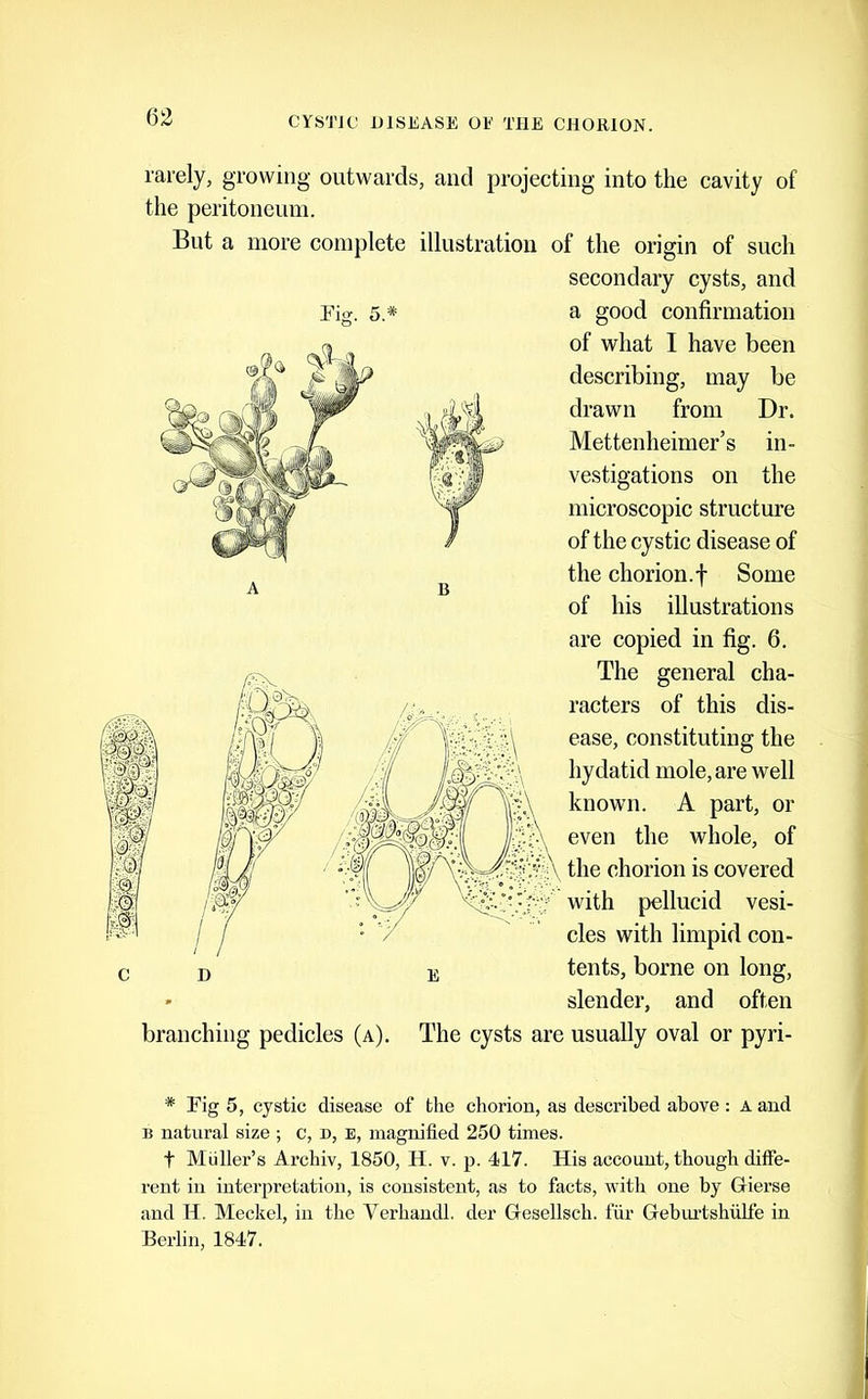 rarely, growing outwards, and projecting into the cavity of the peritoneum. But a more complete illustration of the origin of such secondary cysts, and Pig. 5* a good confirmation of what I have been describing, may be drawn from Dr. Mettenheimer’s in- vestigations on the microscopic structure of the cystic disease of the chorion.f Some of his illustrations are copied in fig. 6. The general cha- racters of this dis- ease, constituting the hydatid mole, are well known. A part, or even the whole, of the chorion is covered with pellucid vesi- cles with limpid con- tents, borne on long, slender, and often The cysts are usually oval or pyri- branching pedicles (a). * Pig 5, cystic disease of the chorion, as described above: A and B natural size ; c, n, E, magnified 250 times. t Muller’s Archiv, 1850, H. v. p. 417. His account, though diffe- rent in interpretation, is consistent, as to facts, with one by Gierse and H. Meckel, in the Verhandl. der Gesellsch. fur Gebui'tshiilfe in Berlin, 1847.