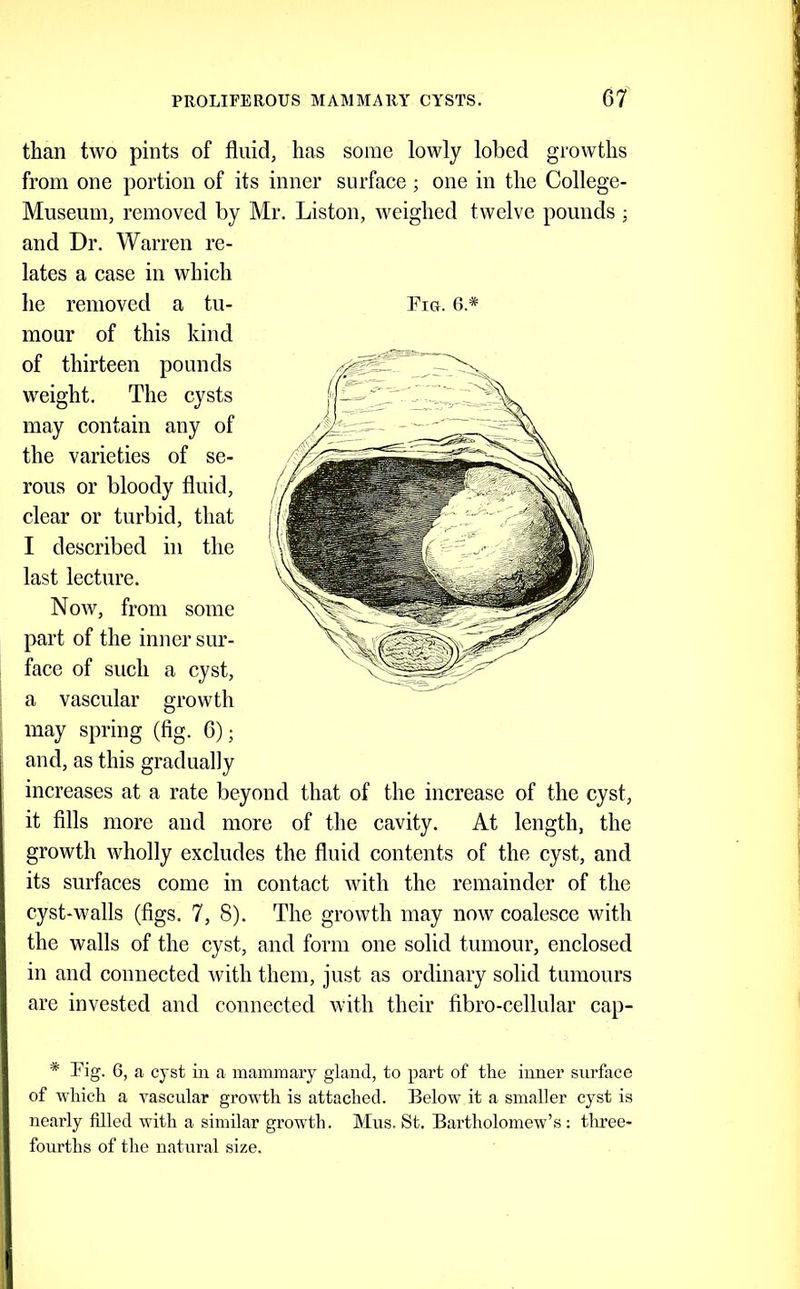 than two pints of fluid, has some lowly lobed growths from one portion of its inner surfaee; one in the College- Museum, removed by Mr. Liston, Aveighed twelve pounds ; and Dr. Warren re- lates a case in which he removed a tu- mour of this kind of thirteen pounds weight. The cysts may contain any of the varieties of se- rous or bloody fluid, clear or turbid, that I described in the last lecture. Now, from some part of the inner sur- face of such a cyst, a vascular growth may spring (fig. 6); and, as this gradually increases at a rate beyond that of the increase of the cyst, ! it fills more and more of the cavity. At length, the I growth wholly excludes the fluid contents of the cyst, and I its surfaces come in contact Avith the remainder of the cyst-walls (figs. 7, 8). The groAvth may noAv coalesce with the walls of the cyst, and form one solid tumour, enclosed in and connected Avith them, just as ordinary solid tumours are invested and connected Avith their fibro-cellular cap- ’ * Fig. 6, a cyst in a mammary gland, to part of the inner surface of which a Avascular growth is attached. Below it a smaller cyst is nearly filled with a similar growth. Mus. St. Bartholomew’s : three- n fourths of the natural size. Fig. 6.*