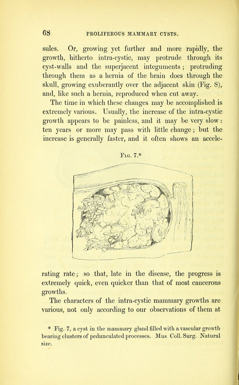 sules. Or, growing yet further and more rapidly, the growth, hitherto intra-cystic, may protrude through its cyst-walls and the superjacent integuments; protruding through them as a hernia of the brain does through the skull, growing exuberantly over the adjacent skin (Fig. 8), and, like such a hernia, reproduced when cut away. The time in which these changes may be accomplished is extremely various. Usually, the increase of the intra-cystic growth appears to be painless, and it may be very slow: ten years or more may pass with little change; but the increase is generally faster, and it often shows an accele- Fia. 7* rating rate; so that, late in the disease, the progress is extremely quick, even quicker than that of most cancerous growths. The characters of the intra-cystic mammary growths are various, not only according to our observations of them at * Kg. 7, a cyst in the mammary gland filled with a vascular growth bearing clusters of pedunculated processes. Mns Coll. Surg. Natural size.