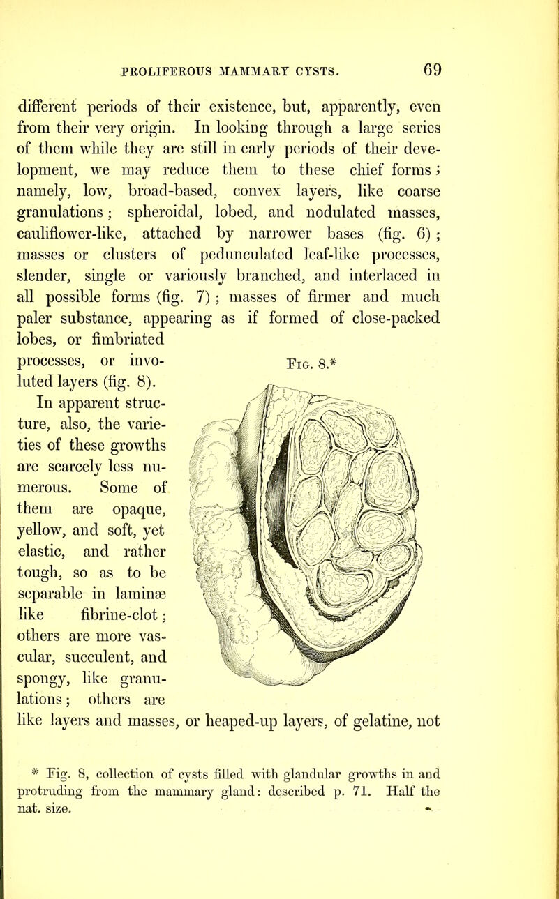 different periods of tlieir existence, but, apparently, even from their very origin. In looking through a large series of them while they are still in early periods of their deve- lopment, we may reduce them to these chief forms; namely, low, broad-based, convex layers, like coarse granulations; spheroidal, lobed, and nodulated masses, cauliflower-like, attached by narrower bases (fig. 6) ; masses or clusters of pedunculated leaf-like processes, slender, single or variously branched, and interlaced in all possible forms (fig. 7) ; masses of firmer and much paler substance, appearing as if formed of close-packed lobes, or fimbriated processes, or invo- Puj. s* luted layers (fig. 8). In apparent struc- ture, also, the varie- ties of these growths are scarcely less nu- merous. Some of them are opaque, yellow, and soft, yet elastic, and rather tough, so as to be separable in laminae like fibrine-clot; others are more vas- cular, succulent, and spongy, like granu- lations ; others are like layers and masses, or heaped-up layers, of gelatine, not * Fig. 8, collection of cysts filled with glandular growths in ai]d protruding from the mammary gland: described p. 71. Half the nat. size.