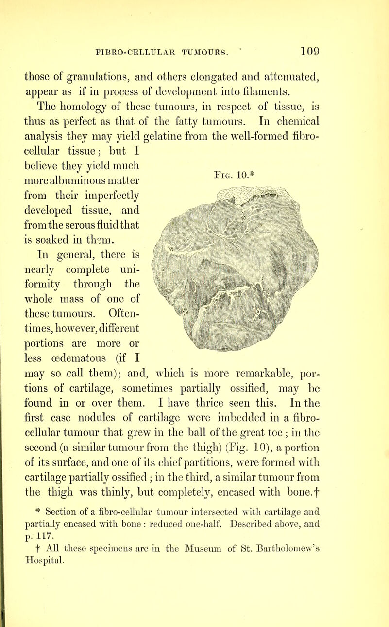 those of granulations, and others elongated and attenuated, appear as if in process of development into filaments. The homology of these tumours, in respect of tissue, is thus as perfect as that of the fatty tumours. In chemical analysis they may yield gelatine from the well-formed fibro- cellular tissue; but I believe they yield much more albuminous matter from their imperfectly developed tissue, and from the serous fluid that is soaked in them. In general, there is nearly complete uni- formity through the whole mass of one of these tumours. Often- times, however, different portions are more or less oedematous (if I may so call them); and, which is more remarkable, por- tions of cartilage, sometimes partially ossified, may be found in or over them. I have thrice seen this. In the first case nodules of cartilage were imbedded in a fibro- cellular tumour that grew in the ball of the great toe ; in the second (a similar tumour from the thigh) (Fig. 10), a portion of its surface, and one of its chief partitions, were formed with cartilage partially ossified ; in the third, a similar tumour from the thigh was thinly, but completely, encased wdth bone.f * Section of a fibro-eellular tumour intersected witli cartilage and partially encased with bone : reduced one-half. Described above, and p. 117. t All these specimens are in the Museum of St. Bartholomew’s Hospital.