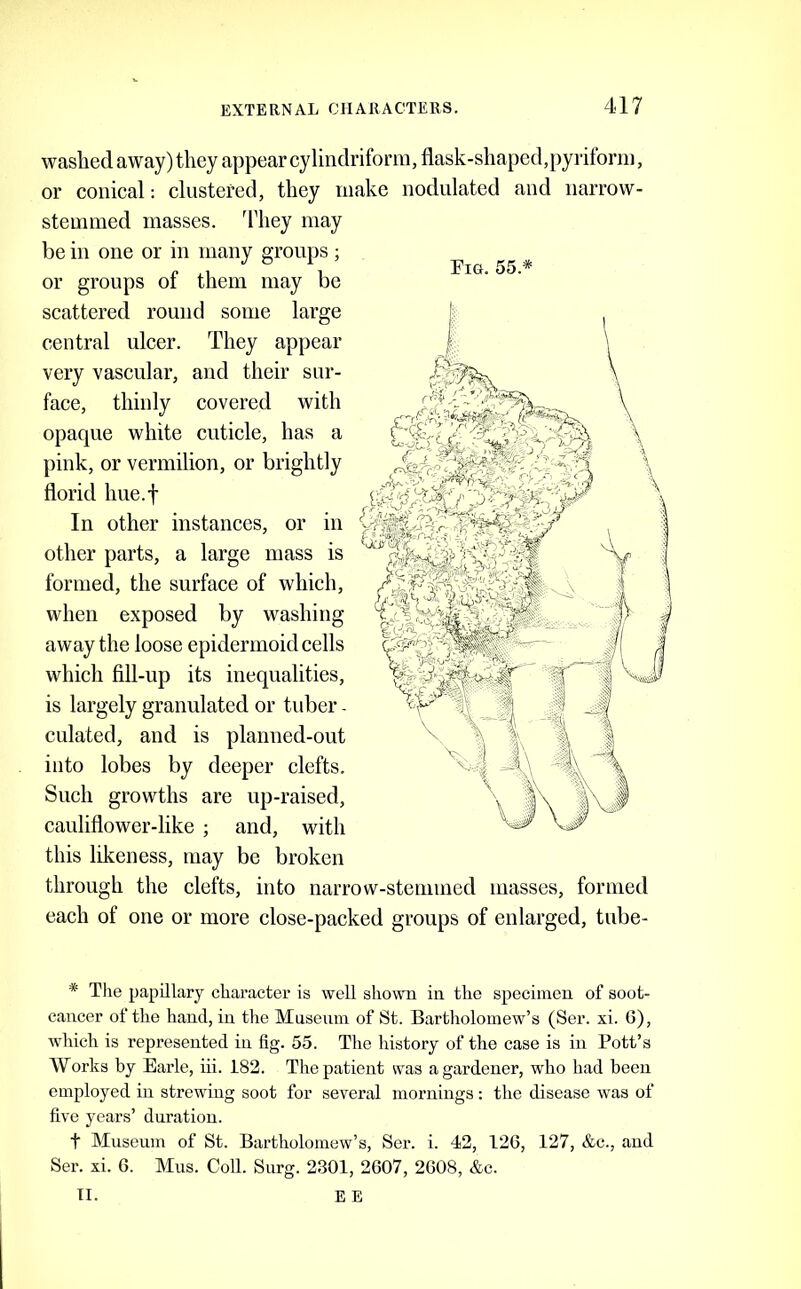 Fig. 55.* washed away) they appear cylindriform, flask-shaped,pyriform, or conical: clustered, they make nodulated and narrow- stemmed masses, ddiey may be in one or in many groups; or groups of them may be scattered round some large central ulcer. They appear very vascular, and their sur- face, thinly covered with opaque white cuticle, has a pink, or vermilion, or brightly florid hue.f In other instances, or in other parts, a large mass is formed, the surface of which, when exposed by washing away the loose epidermoid cells which fill-up its inequalities, is largely granulated or tuber - culated, and is planned-out into lobes by deeper clefts. Such growths are up-raised, cauliflower-like ; and, with this likeness, may be broken through the clefts, into narrow-stemmed masses, formed each of one or more close-packed groups of enlarged, tube- * The papillary character is well sho\ra in the specimen of soot- cancer of the hand, in the Museum of St. Bartholomew’s (Ser. xi. G), which is represented in fig. 55. The history of the case is in Pott’s Works by Earle, iii. 182. The patient was a gardener, who had been employed in strewing soot for several mornings : the disease was of five years’ duration. t Museum of St. Bartholomew’s, Ser. i. 42, 126, 127, &c., and Ser. xi. 6. Mus. Coll. Surg. 2301, 2607, 2608, &c. II. E E