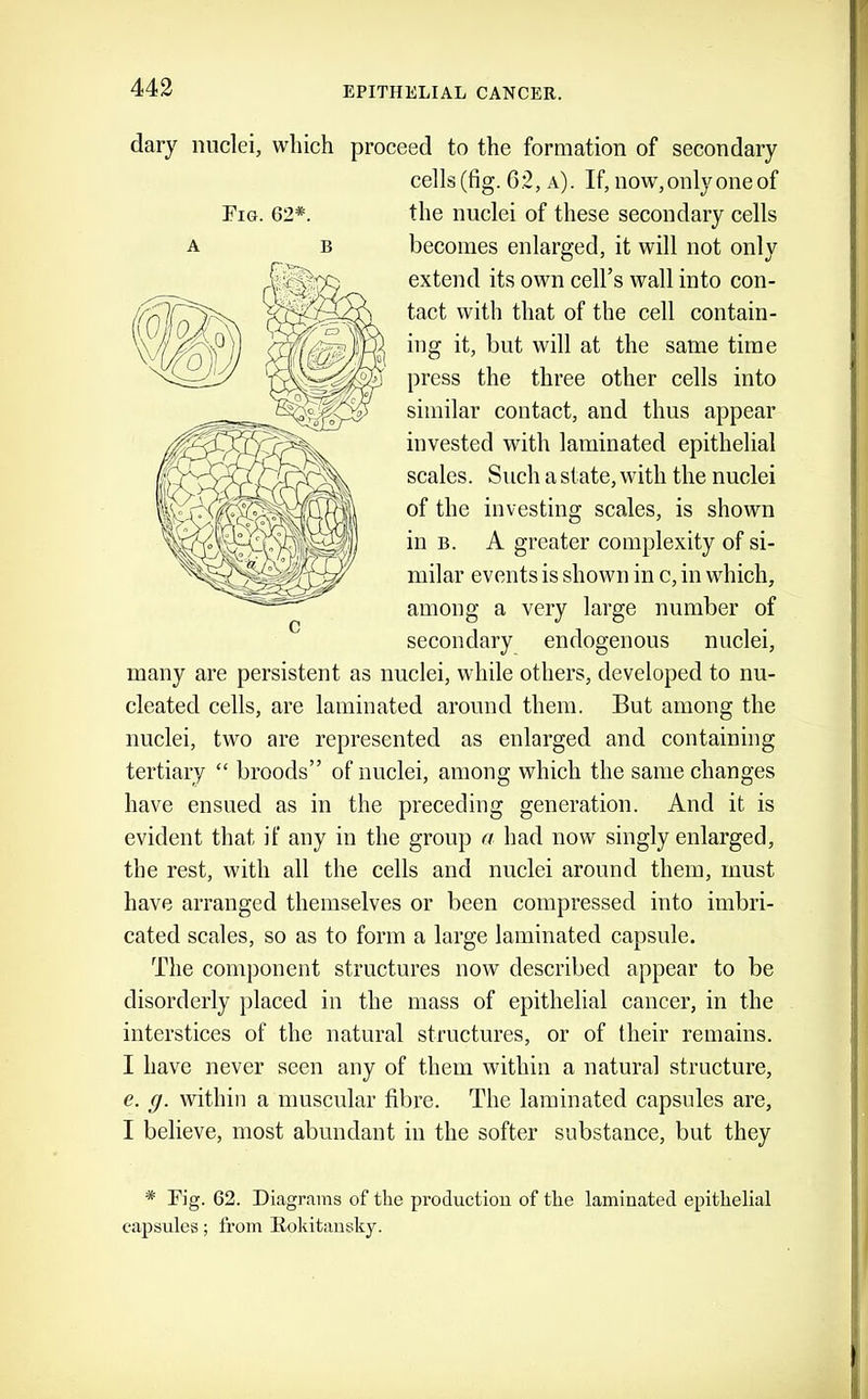 dary nuclei, which proceed to the formation of secondary cells (fig. 62, a). If, now,only oneof the nuclei of these secondary cells becomes enlarged, it will not only extend its own cell’s wall into con- tact with that of the cell contain- ing it, but will at the same time press the three other cells into similar contact, and thus appear invested with laminated epithelial scales. Such a state, with the nuclei of the investing scales, is shown in B. A greater complexity of si- milar events is shown in c, in which, among a very large number of secondary endogenous nuclei, many are persistent as nuclei, while others, developed to nu- cleated cells, are laminated around them. But among the nuclei, two are represented as enlarged and containing tertiary “ broods” of nuclei, among which the same changes have ensued as in the preceding generation. And it is evident that if any in the group a had now singly enlarged, the rest, with all the cells and nuclei around them, must have arranged themselves or been compressed into imbri- cated scales, so as to form a large laminated capsule. The component structures now described appear to be disorderly placed in the mass of epithelial cancer, in the interstices of the natural structures, or of their remains. I have never seen any of them within a natural structure, e. g. within a muscular fibre. The laminated capsules are, I believe, most abundant in the softer substance, but they * Fig. 62. Diagrams of the production of the laminated epithelial capsules; from Itokitausky. Fig. 62*. A B