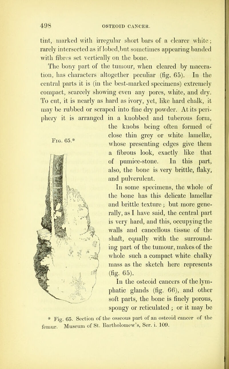 tint, marked with irregular short bars of a clearer white; rarely intersected as if lobed,bnt sometimes appearing banded with fibres set vertically on the bone. The bony part of the tumour, when cleared by macera- tion, has characters altogether peculiar (fig. 65). In the central parts it is (in the best-marked specimens) extremely compact, scarcely showing even any pores, white, and dry. To cut, it is nearly as hard as ivory, yet, like hard chalk, it may be rubbed or scraped into fine dry powder. At its peri- phery it is arranged in a knobbed and tuberous form, the knobs being often formed of close thin grey or white lamella3, whose presenting edges give them a fibrous look, exactly like that of pumice-stone. In this part, also, the bone is very brittle, flaky, and pulverulent. In some specimens, the whole of the bone has this delicate lamellar and brittle texture; but more gene- rally, as I have said, the central part is very hard, and this, occupying the walls and cancellous tissue of the shaft, equally with the surround- ing part of the tumour, makes of the whole such a compact white chalky mass as the sketch here represents (fig. 65). In the osteoid cancers of the lym- phatic glands (fig. 66), and other soft parts, the bone is finely porous, spongy or reticulated ; or it may be * Fig. 65. Section of the osseous part of an osteoid cancer of the femur. Museum of St. Bartholomew’s, Ser. i. 109. Fi&. 65.*