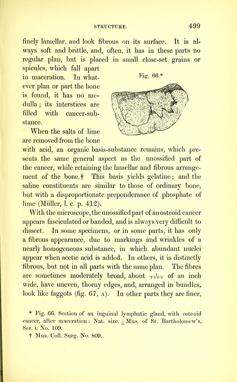 finely lamellar, and look fibrous on its surface. It is al- ways soft and brittle, and, often, it has in these parts no regular plan, but is placed in small close-set grains or spicules, which fall apart ever plan or part the bone is found, it has no me- dulla ; its interstices are filled with cancer-sub- stance. When the salts of lime are removed from the bone with acid, an organic basis-substance remains, which pre- sents the same general asj)ect as the unossified part of the cancer, while retaining the lamellar and fibrous arrange- ment of the bone.f This basis yields gelatine; and the saline constituents are similar to those of ordinary bone, but with a disproportionate preponderance of phosphate of lime (Muller, 1. c. p. 412). With the microscope, the unossified part of an osteoid cancer appears fasciculated or banded, and is always very difficult to dissect. In some specimens, or in some parts, it has only a fibrous appearance, due to markings and wrinkles of a nearly homogeneous substance, in which abundant nuclei appear when acetic acid is added. In others, it is distinctly fibrous, but not in all parts with the same plan. The fibres are sometimes moderately broad, about toVtt of an inch wide, have uneven, thorny edges, and, arranged in bundles, look hke faggots (fig. 67, a). In other parts they are finer, * Fig. 66. Section of an inguinal lymphatic gland, with osteoid cancer, after maceration : Nat. size. ^Mus. of St. Bartholomew’s, Ser. i. No. 109. t Mus. Coll. Surg. No. 809.