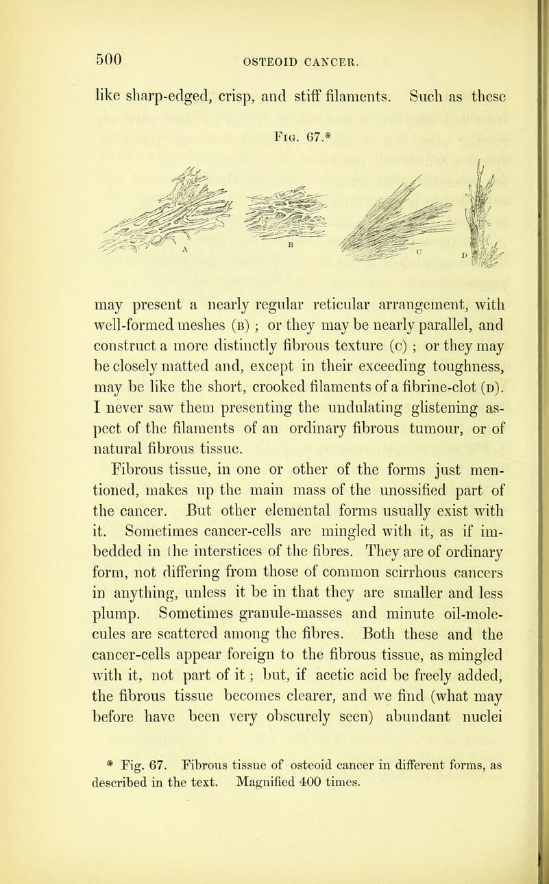 like sharp-edged, crisp, and stiff filameDts. Such as these Fiu. 67.* may present a nearly regular reticular arrangement, with well-formed meshes (b) ; or they may be nearly parallel, and construct a more distinctly fibrous texture (c) ; or they may be closely matted and, except in their exceeding toughness, may be like the short, crooked filaments of a fibrine-clot (d). I never saw them presenting the undulating glistening as- pect of the filaments of an ordinary fibrous tumour, or of natural fibrous tissue. Fibrous tissue, in one or other of the forms just men- tioned, makes up the main mass of the unossified part of the cancer. But other elemental forms usually exist with it. Sometimes cancer-cells are mingled with it, as if im- bedded in the interstices of the fibres. They are of ordinary form, not differing from those of common scirrhous cancers in anything, unless it be in that they are smaller and less plump. Sometimes granule-masses and minute oil-mole- cules are scattered among the fibres. Both these and the cancer-cells appear foreign to the fibrous tissue, as mingled with it, not part of it; but, if acetic acid be freely added, the fibrous tissue becomes clearer, and we find (what may before have been very obscurely seen) abundant nuclei * Tig. 67. Eibrous tissue of osteoid cancer in different forms, as described in the text. Magnified 400 times.