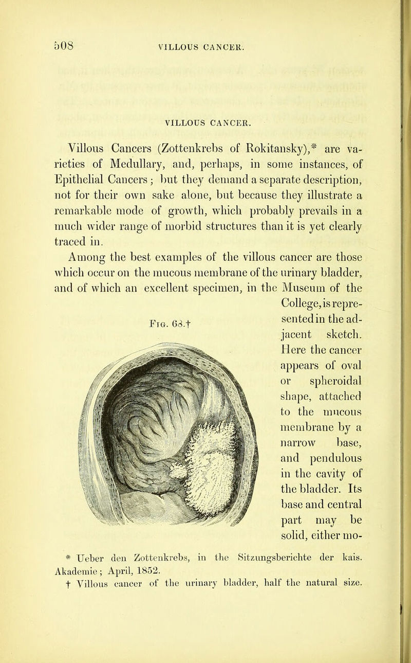 VILLOUS CANCER. Villous Cancers (Zottenkrebs of Rokitansky),are va- rieties of Medullary, and, perhaps, in some instances, of Epithelial Cancers; but they demand a separate description, not for their own sake alone, but because they illustrate a remarkable mode of growth, which probably prevails in a much wider range of morbid structures than it is yet clearly traced in. Among the best examples of the villous cancer are those which occur on the mucous membrane of the urinary bladder, and of which an excellent specimen, in the Museum of the College, is repre- sented in the ad- jacent sketch. Here the cancer appears of oval or spheroidal shape, attached to the mucous meiidirane by a narrow base, and pendulous in the cavity of the bladder. Its base and central part may be solid, either mo- * Ueber (leu Zottenkrebs, in the Sitzungsbericbte der kais. Akadeinie; April, 1852. t Villous cancer of the urinary bladder, half the natural size.