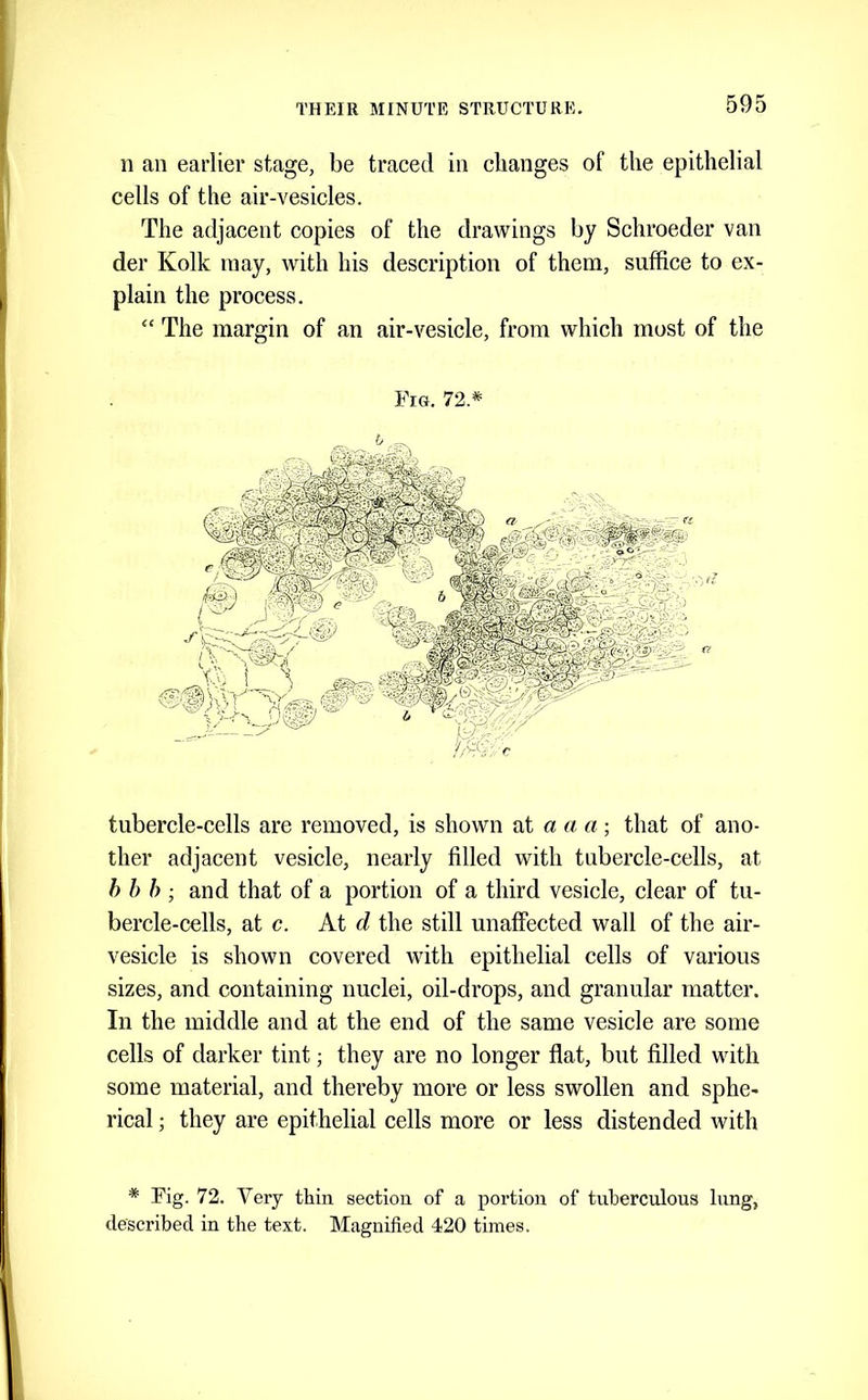 n an earlier stage, be traced in changes of the epithelial cells of the air-vesicles. The adjacent copies of the drawings by Schroeder van der Kolk may, with his description of them, suffice to ex- plain the process. “ The margin of an air-vesicle, from which most of the Fig. 72.* tubercle-cells are removed, is shown at a a a ; that of ano- ther adjacent vesicle, nearly filled with tubercle-cells, at h b h ; and that of a portion of a third vesicle, clear of tu- bercle-cells, at c. At d the still unaffected wall of the air- vesicle is shown covered with epithelial cells of various sizes, and containing nuclei, oil-drops, and granular matter. In the middle and at the end of the same vesicle are some cells of darker tint; they are no longer flat, but filled with some material, and thereby more or less swollen and sphe- rical ; they are epithelial cells more or less distended with * Fig. 72. Very thin section of a portion of tiiherculous lung, described in the text. Magnified 420 times.