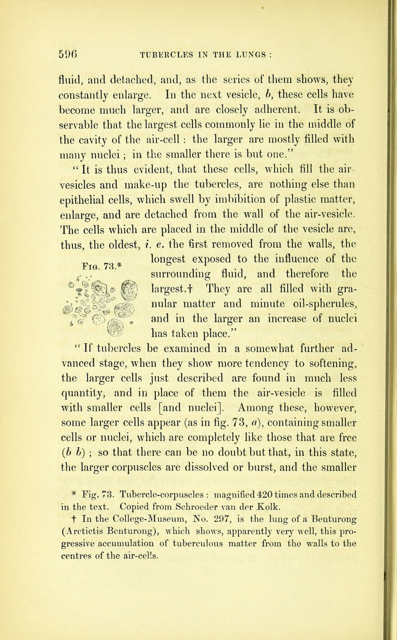 fluid, and detached, and, as the series of them shows, they constantly enlarge. In the next vesicle, h, these cells have become much larger, and are closely adherent. It is ob- servable that the largest cells commonly lie in the middle of the cavity of the air-cell: the larger are mostly filled with many nuclei; in the smaller there is but one.” “ It is thus evident, that these cells, which fill the air- vesicles and make-up the tubercles, are nothing else than epithelial cells, which swell by imbibition of plastic matter, enlarge, and are detached from the wall of the air-vesicle. The cells which are placed in the middle of the vesicle are, thus, the oldest, i. e. the first removed from the walls, the “ If tubercles be examined in a somewhat further ad- vanced stage, when they show more tendency to softening, the larger cells just described are found in much less quantity, and in place of them the air-vesicle is filled Avith smaller cells [and nuclei]. Among these, however, some larger cells appear (as in fig. 73, a), containing smaller cells or nuelei, which are completely like those that are free {h h) ; so that there can be no doubt but that, in this state, the larger corpuscles are dissolved or burst, and the smaller * Pig. 73. Tubercle-corpuscles: magnified 420 times and described in the text. Copied from Schroeder ran der Kolk. t In the College-Museum, No. 297, is the lung of a Beuturong (Arctictis Bcnturong), which shows, apparently very well, this pro- gressive accumulation of tubercidous matter from the walls to the centres of the air-cells. Pig. 73.* longest exposed to the influence of the surrounding fluid, and therefore the largest.! They are all filled with gra- nular matter and minute oil-spherules, and in the larger an increase of nuclei has taken place.”