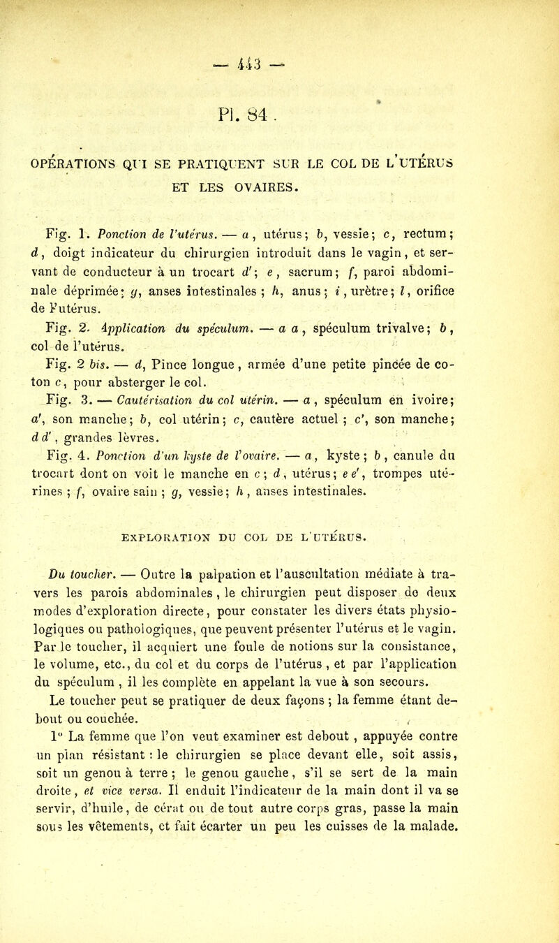 — U 3 — Pi. 84 . OPÉRATIONS QUI SE PRATIQUENT SUR LE COL DE L’UTERUS ET LES OVAIRES. Fig. 1. Ponction de l’utérus. — a, utérus; b, vessie; c, rectum; d, doigt indicateur du chirurgien introduit dans le vagin, et ser- vant de conducteur à un trocart d'; e , sacrum; f, paroi abdomi- nale déprimée? </, anses intestinales; h, anus; i, urètre; Z, orifice de F utérus. Fig. 2. Application du spéculum. —a a, spéculum trivalve; b, col de l’utérus. Fig. 2 bis. — d, Pince longue , armée d’une petite pincée de co- ton c, pour absterger le col. Fig. 3. — Cautérisation du col utérin. — a , spéculum en ivoire; a\ son manche; b, col utérin; c, cautère actuel ; c’, son manche; dd', grandes lèvres. Fig. 4. Ponction d’un kyste de Vovaire. — a, kyste ; b , canule du trocart dont on voit le manche en c ; d, utérus; e e\ trompes uté- rines ; f, ovaire sain ; g, vessie; h, anses intestinales. EXPLORATION DU COL DE L'UTERUS. Du toucher. — Outre la palpation et l’auscultation médiate à tra- vers les parois abdominales , le chirurgien peut disposer de deux modes d’exploration directe, pour constater les divers états physio- logiques ou pathologiques, que peuvent présenter l’utérus et le vagin. Par le toucher, il acquiert une foule de notions sur la consistance, le volume, etc., du col et du corps de l’utérus , et par l’application du spéculum , il les Complète en appelant la vue à son secours. Le toucher peut se pratiquer de deux façons ; la femme étant de- bout ou couchée. , 1° La femme que l’on veut examiner est debout , appuyée contre un plan résistant : le chirurgien se place devant elle, soit assis, soit un genou à terre ; le genou gauche, s’il se sert de la main droite, et vice versa. Il enduit l’indicateur de la main dont il va se servir, d’huile, de cérat ou de tout autre corps gras, passe la main sous les vêtements, et fait écarter un peu les cuisses de la malade.