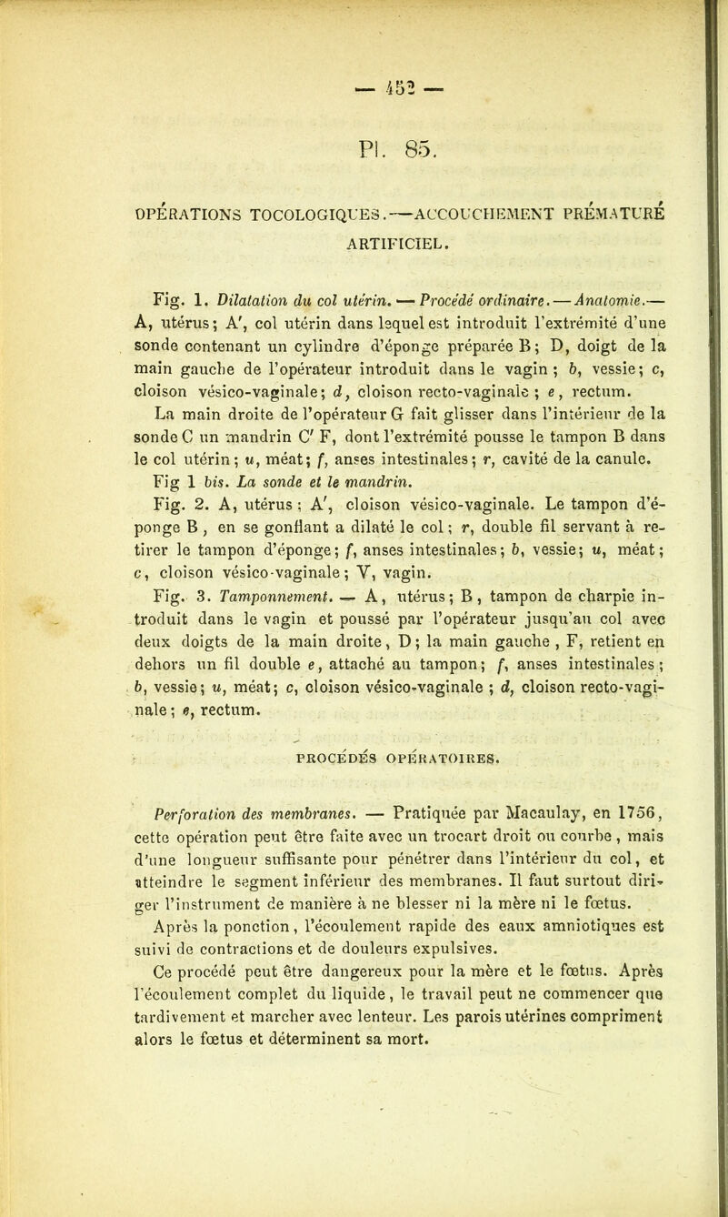 PL 85. OPÉRATIONS TOCOLOGIQUES. ACCOUCHEMENT PREMATURE ARTIFICIEL. Fig. 1. Dilatation du col utérin.Procédé ordinaire. — Anatomie.— A, utérus; Acol utérin dans lsquelest introduit l’extrémité d’une sonde contenant un cylindre d’éponge préparée B; D, doigt de la main gauche de l’opérateur introduit dans le vagin; 6, vessie; c, cloison vésico-vaginale; d} cloison recto-vaginale ; e, rectum. La main droite de l’opérateur G fait glisser dans l’intérieur de la sonde C un mandrin C' F, dont l’extrémité pousse le tampon B dans le col utérin; m, méat; f, anses intestinales; r, cavité de la canule. Fig 1 bis. La sonde et le mandrin. Fig. 2. A, utérus ; A', cloison vésico-vaginale. Le tampon d’é- ponge B, en se gonflant a dilaté le col ; r, double fil servant à re- tirer le tampon d’éponge; f, anses intestinales; 6, vessie; u, méat; c, cloison vésico-vaginale; Y, vagin. Fig. 3. Tamponnement. — A, utérus; B, tampon de charpie in- troduit dans le vagin et poussé par l’opérateur jusqu’au col avec deux doigts de la main droite, D; la main gauche , F, retient en dehors un fil double e, attaché au tampon; f, anses intestinales; b, vessie; u, méat; c, cloison vésico-vaginale ; d, cloison recto-vagi- nale ; e} rectum. PROCEDES OPÉRATOIRES. Perforation des membranes. — Pratiquée par Macaulay, en 1756, cette opération peut être faite avec un trocart droit ou courbe, mais d’une longueur suffisante pour pénétrer dans l’intérieur du col, et atteindre le segment inférieur des membranes. Il faut surtout diri- ger l’instrument de manière à ne blesser ni la mère ni le fœtus. D Après la ponction, l’écoulement rapide des eaux amniotiques est suivi de contractions et de douleurs expulsives. Ce procédé peut être dangereux pour la mère et le fœtus. Après l’écoulement complet du liquide, le travail peut ne commencer que tardivement et marcher avec lenteur. Les parois utérines compriment alors le fœtus et déterminent sa mort.