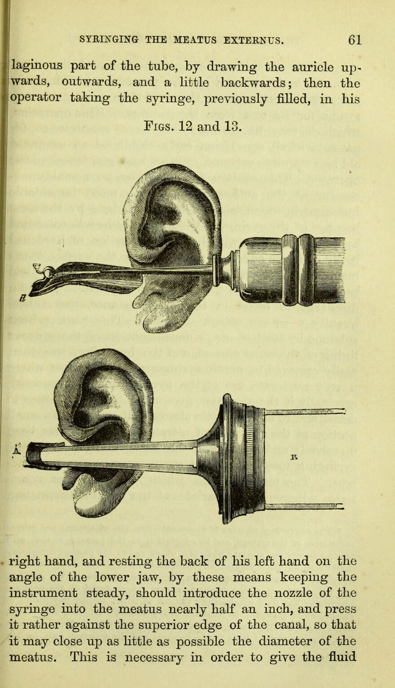 laginous part of the tube, by drawing the auricle up- wards, outwards, and a little backwards; then the operator taking the syringe, previously filled, in his Figs. 12 and 13. right hand, and resting the back of his left hand on the angle of the lower jaw, by these means keeping the instrument steady, should introduce the nozzle of the syringe into the meatus nearly half an inch, and press it rather against the superior edge of the canal, so that it may close up as little as possible the diameter of the meatus. This is necessary in order to give the fluid