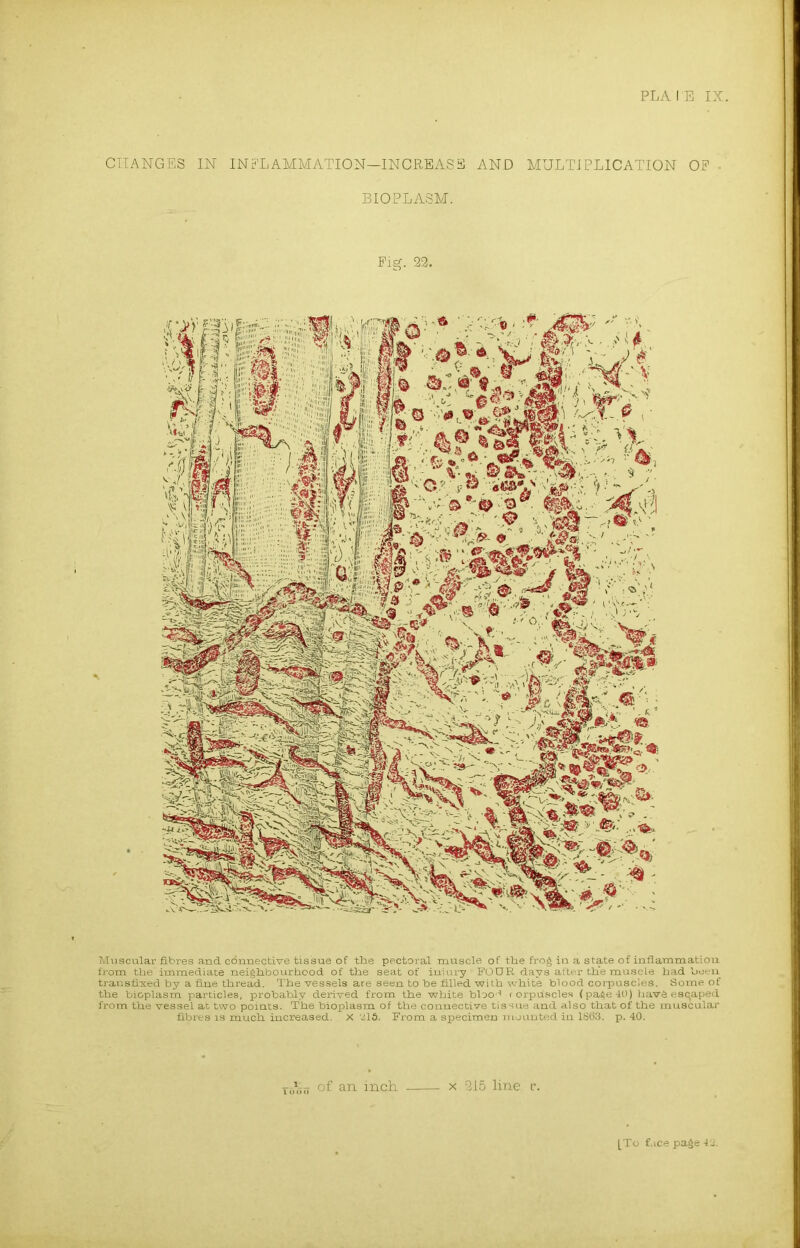 CHANGES IN INFLAMMATION—INCREASE AND MULTIPLICATION OF BIOPLASM. Fig. 22. Muscular fibres and connective tissue of the pectoral muscle of the frog in a state of inflammation from the immediate neighbourhood of the seat of iuiury FOUR days after the muscle had been transfixed by a fine thread. The vessels are seen to he filled with white blood corpuscles. Some of the bioplasm particles, probably derived from the white bloo-t < orpuscles (page 40) havS escaped from the vessel at two points. The bioplasm of the connective tissue and also that of the muscular fibres is much increased. X 21S. From a specimen mounted iu 1863. p. 40. of an inch. x 215 line c.