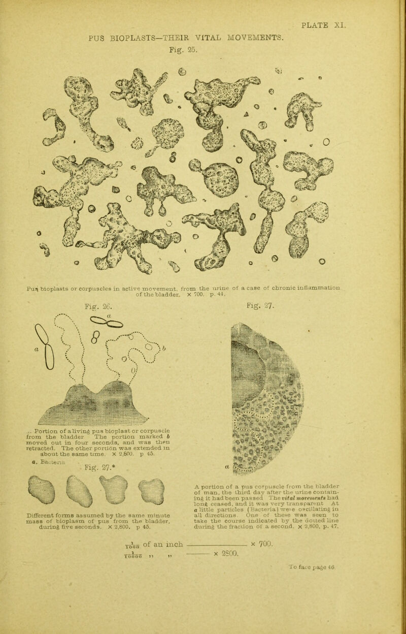 PLATE XI. PUS BIOPLASTS—THEIR VITAL MOVEMENTS. Fig. 25. Puq bioplasts or corpuscles in active movement, from the urine of a case of chronic inflammation of the bladder. X 700. p. 44.. Fig. 26. Fig. 27. ... Portion of a living pus bioplast or corpuscle from the bladder The portion marked b moved out in four seconds, and was then retracted. The other portion was extended in about the same time. X 2,600. p 45. Different forms assumed by the same minute mass of bioplasm of pus from the bladder, during five seconds. X 2,800. p 45. A portion of a pus corpuscle from the bladder of man, the third day after the urine contain- ing it had been passed Th evital movements had long ceased, and it was very transparent At a little particles (Bacteria) weie oscillating in all directions. One of these was seen to take the course indicated by the dotted line during the fraction of a second, x 2,800, p. 47. ■jThjj of an inch To ooo »i X 700. x 2S00.