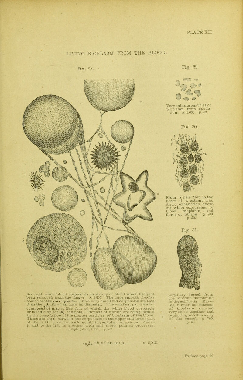 LIVING BIOPLASM FROM THE BLOOD. Fig. 28. Fig. 29. Red and white blood corpuscles in a drop of blood which had just been removed from the finger x 2,800 The large smooth circular bodies are the red corpuscles. Three very small red corpuscles are less than the _JL_th of an inch in diameter. The smallest particles are composed of matter like that of which the white blood corpusole or blood bioplast (6) consists. Threads of fibrine are being formed by the coagulation of the minute particles of bioplasm of the blood These are seen between the corpuscles in the upper and lower part of the field a red corpuscle exhibiting angular projections Above it and to the left is another with still more pointed processes. September, 1863. p, 62. •-L s. ( .-. t3 0 <m & Very minute particles of bioplasm from exuda- tion. x 5,000. p. 52. Fig. 30. From a pale clot in the heart of a patient who died of exhaustion, show- ing white corpuscles, or blood bioplasts, . and fibres of fibrine x 100. P.S2. Fig. 31. Capillary vessel, from the mucous membrane of the epiglottis. Show- ing numerous masses of bioplasm situated very close together and projecting into the cavity of the vessel, x 100. p. 53. is iiooth. of an inch x 2,800. [To face page 52.