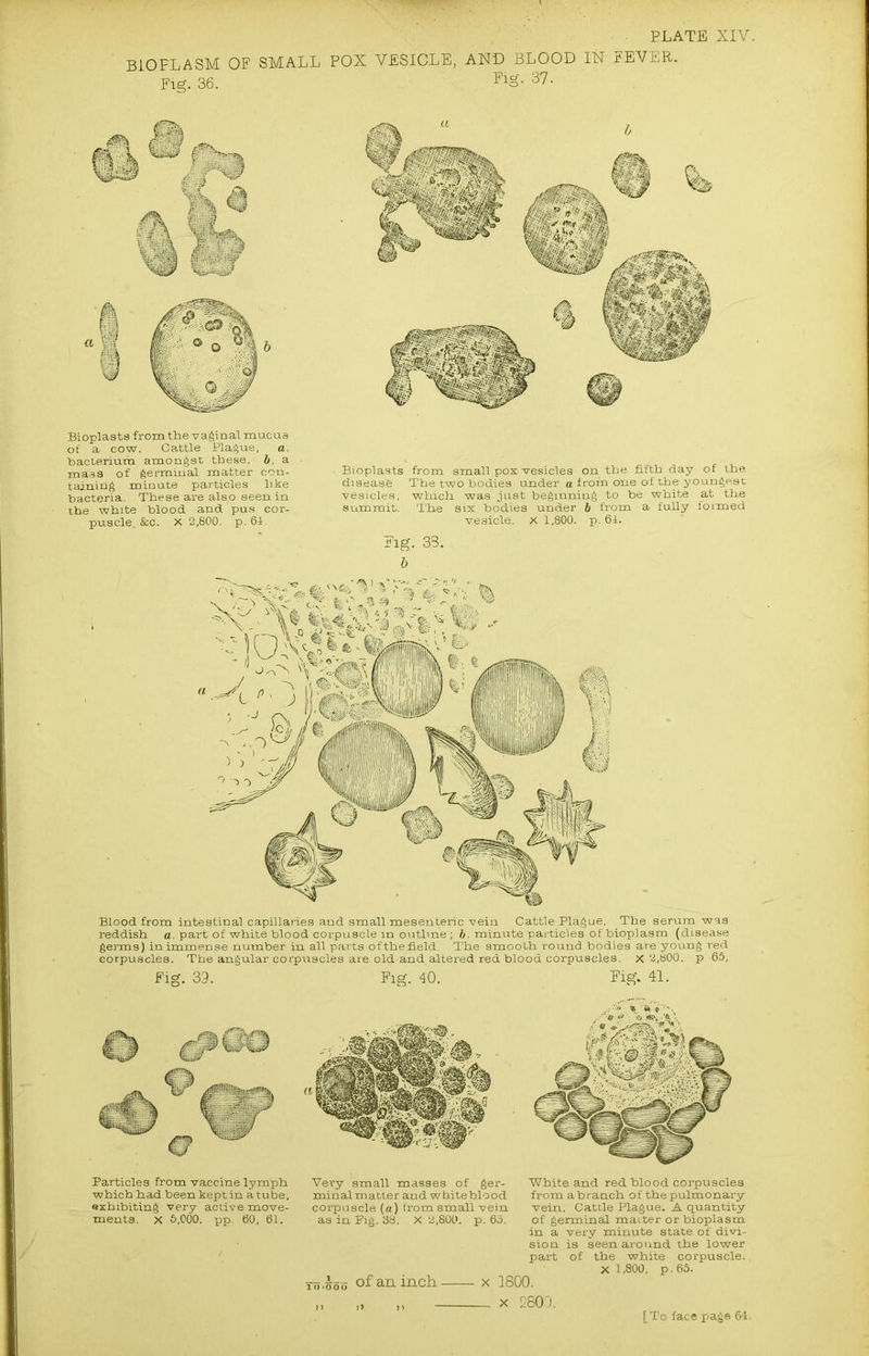 BIOPLASM OF Fig. 36. PLATE XIV. SMALL POX VESICLE, AND BLOOD IN FEVER. Fig. 37. Bioplasts from the vagin al mucus of a- cow. Cattle Plague, a. bacterium amongst these, b, a mass of germinal matter con- taining minute particles like bacteria. These are also seen in the white blood and pus cor- puscle. &c. X 2,800. p.64. ■ Bioplasts from small pox vesicles on the fifth day of the diseasfe The two bodies under a from one of the youngest vesicles, which was just beginning to be white at the summit. The six bodies under b from a fully formed vesicle. X 1,800. p. 61. Fig. 38. b Blood from intestinal capillaries and small mesenteric vein Cattle Plague. The serum was reddish a, part of white blood corpuscle in outline ; b. minute particles of bioplasm (disease germs) in immense number in all parts ofthefield. The smooth round bodies are young red corpuscles. The angular corpuscles are old and altered red blood corpuscles, x 2,800. p 65, Fig. 39. Fig. 40. Fig. 41. Particles from vaccine lymph which h ad been kept in a tube, exhibiting very active move- ments. X 6,000. pp. 60, 61. Very small masses of ger- minal matter and white blood corpuscle (a) from small vein as in Fig. 38. X 2,800. p. 65. White and red blood corpuscles from abranch of the pulmonary vein. Cattle Plague. A quantity of germinal matter or bioplasm in a very minute state of divi- sion is seen around the lower part of the white corpuscle. X 1,800, p. 65. To.ooo of an inch x 1800. - x 2800.