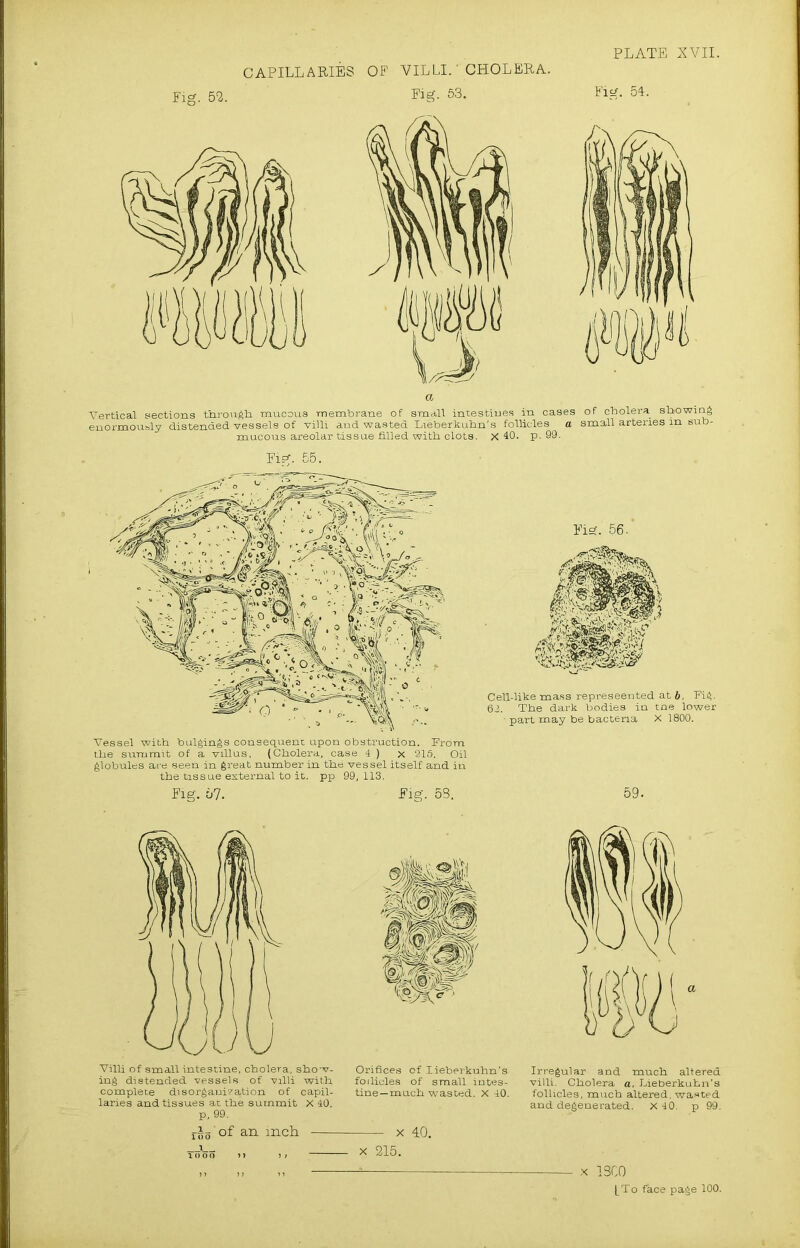 CAPILLARIES OP VILLI. ‘ CHOLERA. Fig. 52. Eig. 53. Fig. 54. a ■Vertical sections through mucous membrane of small intestines in cases of cholera showing enormously distended vessels of villi and wasted Lieberkuhn's follicles a small arteries in sub- mucous areolar tissue filled with, clots. X 40. p. 99. Eig. 55. Vessel with bulgings consequent upon obstruction. Prom the summit of a villus, (Cholera, case 4 ) x ‘215. Oil globules are seen in great number in the vessel itself and in the tissue external to it. pp 99,113. Eig. 67. Eig. 58. Eig. 56. Cell-like mass represeented at b, Fig. 63. The dark bodies in tine lower ■ part may be bacteria X 1800. 59. Villi of small intestine, cholera, show- ing distended vessels of villi with complete disorganisation of capil- laries and tissues at the summit X 40. ri5 of an inch Orifices of lieberkuhn’s follicles of small intes- tine—much wasted. X 40. x 40. x 215. Irregular and much altered villi. Cholera a. Lieberkuhn’s follicles, much altered, wasted and degenerated. X 40. p 99. X 13C0