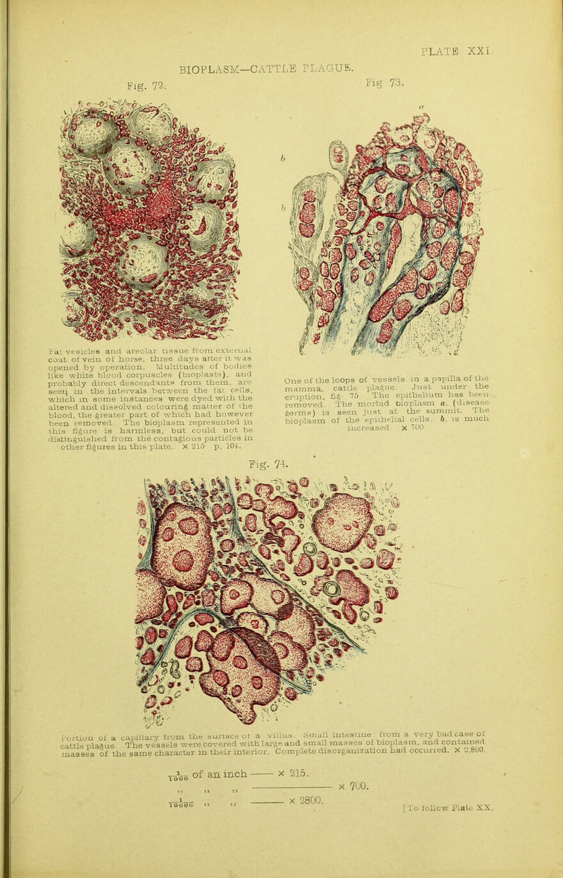 BIOPLASM—CATTLE PLAGUE. Fig. 72. Fat vesicles and areolar tissue from external coat of'vein of horse, three days alter it was opened by operation. Multitudes of bodies like white blood corpuscles (bioplasts), and probably direct descendants from them, are seerj in the intervals between the fat cells, which m some instances were dyed with the altered and dissolved colouring matter of the blood, the greater part of which had however been removed. The bioplasm represented in this figure is harmless, but could not bp-, distinguished from the contagious particles in other figures in this plate. X 215 p. 101. Eig 73. One of the loops of vessels in a papilla of the mamma, cattle plague. Just under the eruption, fig.- 75 The epithelium has been- removed’. The morbid bioplasm a. (disease germs) is seen just at the summit. The bioplasm of the epithelial cells, b, is much increased. X 700. Eig- 74. Portion of a capillary from the surface of a villus. Small intestine - from a very bad case of cattle plague The vessels were covered withlarge and small masses of bioplasm, and contained masses of the same character in their interior. Complete disorganization had occurred. X J.800. __h_ of an inch x 215. x 700. x 2800.