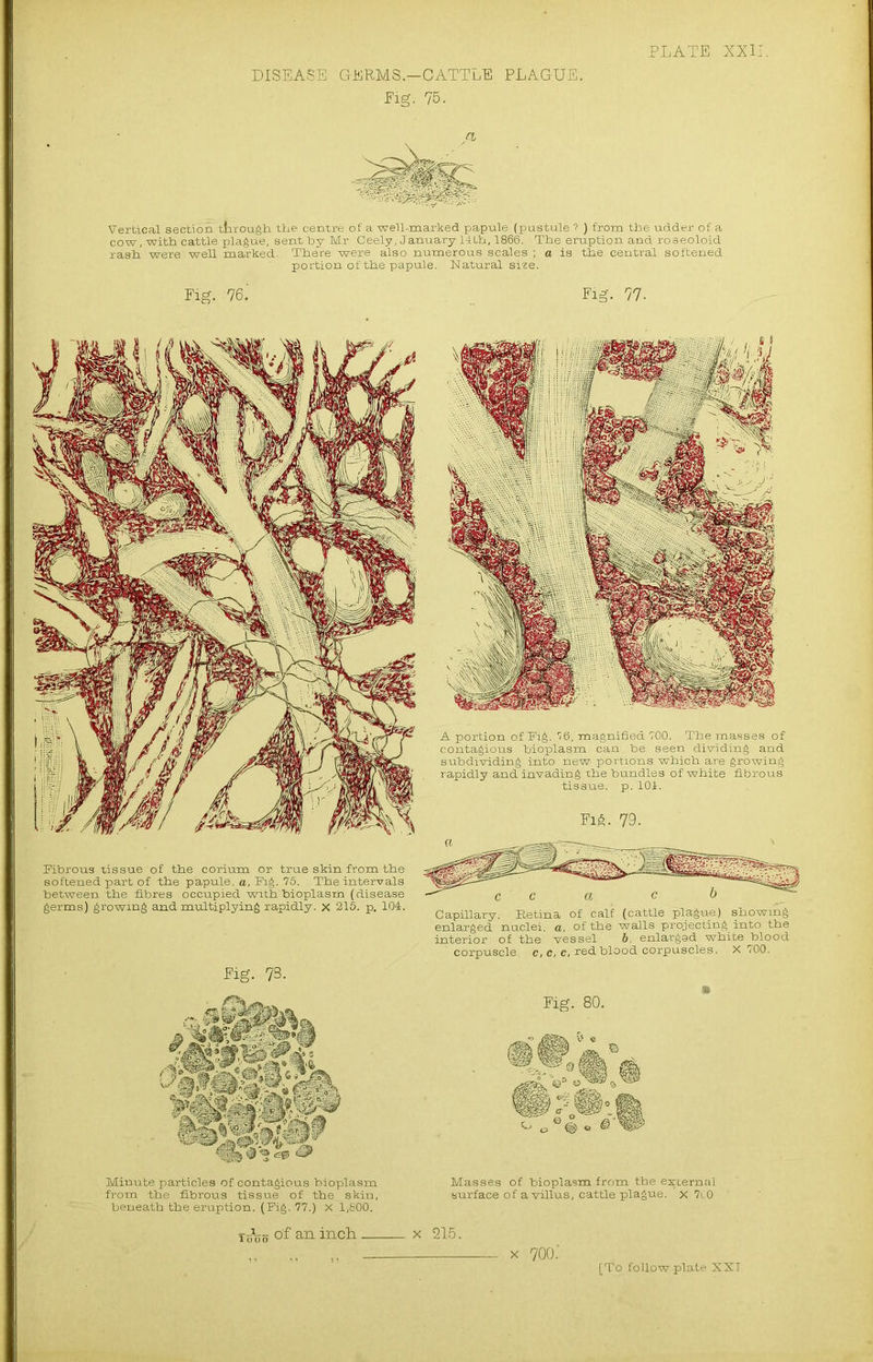 DISEASE GERMS.—CATTLE. PLAGUE. Fig. 75. Vertical section through the centre of a well-marked papule (pustule ? ) from the udder of a cow, with cattle plague, sent by Mr Ceely, January 14th, 1866. The eruption and roaeoloid rash were well marked. There were also numerous scales ; a is the central softened portion of the papule. Natural size. Fig. 76.' Fig. 77- Fibrous tissue of the eorium or true skin from the softened part of the papule, a, Fig. 75. The intervals between the fibres occupied with bioplasm (disease germs) growing and multiplying rapidly, x 215. p, 104. A portion of Fig. 76, magnified 700. The masses of contagious bioplasm can be seen dividing and subdividing into new portions which are growing rapidly and invading the bundles of white fibrous tissue, p. 101. Fig. 79. Capillary; Retina of calf (cattle plague) showing enlarged nuclei, a, of the walls projecting into the interior of the vessel b, enlargsd white blood corpuscle, c, c, c, red blood corpuscles. X 700. Fig. 73. Minute particles of contagious bioplasm Masses of bioplasm from the external from the fibrous tissue of the skin, surface of a villus, cattle plague, x 7C0 beneath the eruption, (Fig. 77.) x 1,800. t (Hio arL inch x 215. ,, x 7oo: