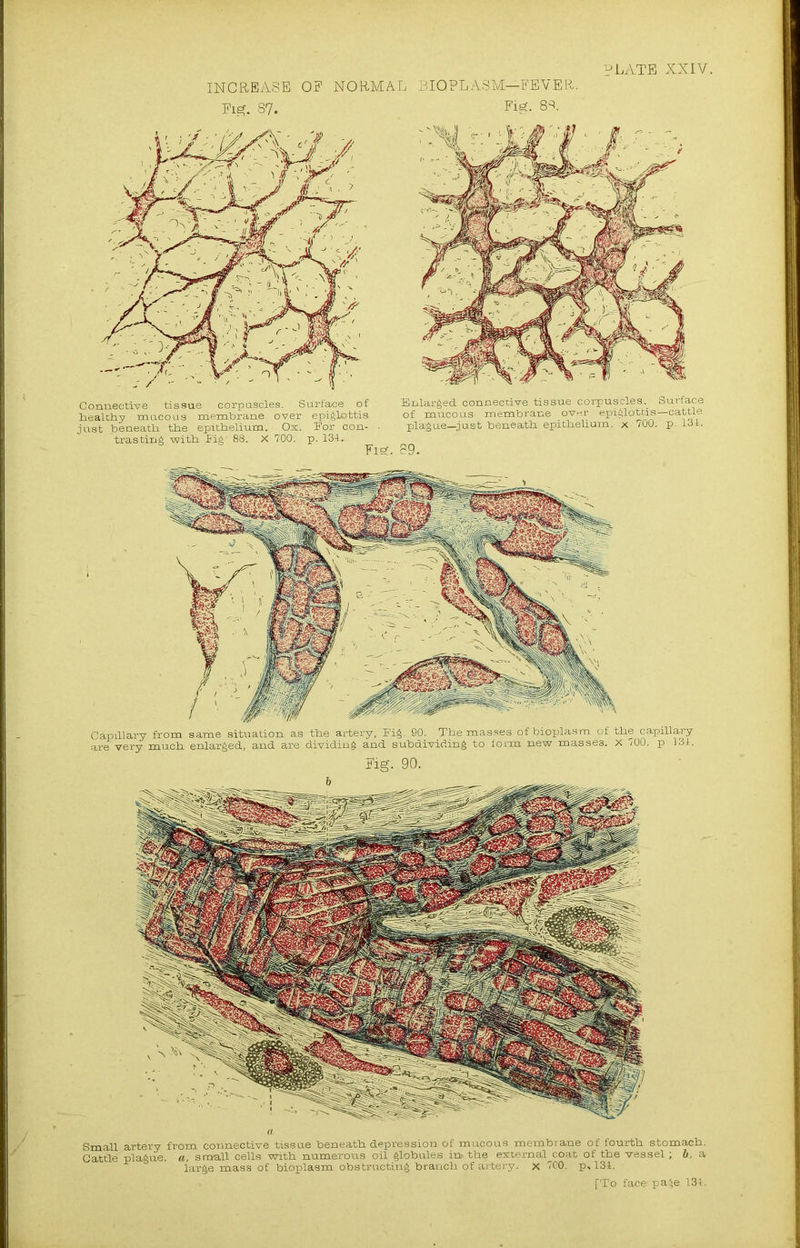 INCREASE OP NORMAL LICfPLASM—FEVER. Pig. 87. . Fig- 8R Connective tissue corpuscles. Surface of healthy mucous membrane over epiglottis just beneath the epithelium. Ox. For con- trasting with Fig- 88. X 700. p. 134. Enlarged connective tissue corpuscles. Surface of mucous membrane over epiglottis—cattle plague—just beneath epithelium, x 700. p. 131. 89. Capillary from same situation as the artery. Fig. 90. The masses of bioplasm of the capillary are very much enlarged, and are dividing and subdividing to form new masses. X 700. p 131. Pig. 90. Small artery from connective tissue beneath depression of mucous membrane of fourth stomach. Cattle plague, a, small cells with numerous oil globules in> the external coat of the vessel; b. a large mass of bioplasm obstructing branch of artery, x 700. p, 131.