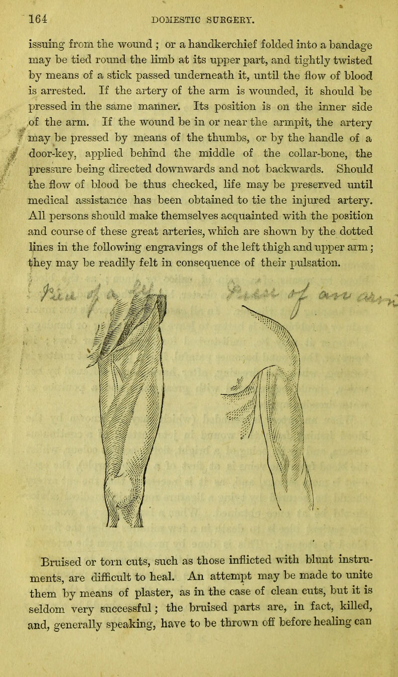 issuing from the wound ; or a handkerchief folded into a bandage may be tied round the limb at its upper part, and tightly twisted by means of a stick passed underneath it, until the flow of blood is arrested. If the artery of the arm is wounded, it should he pressed in the same manner. Its position is on the inner side of the arm. If the wound be in or near the armpit, the artery f may be pressed by means of the thumbs, or by the handle of a door-key, applied behind the middle of the collar-bone, the pressure being directed downwards and not backwards. Should the flow of blood be thus checked, life may be preserved until medical assistance has been obtained to tie the injured artery. All persons should make themselves acquainted with the position and course of these great arteries, which are shown by the dotted lines in the following engravings of the left thigh and upper arm; they may be readily felt in consequence of their pulsation. Bruised or torn cuts, such as those inflicted with blunt instru- ments, are diflicult to heal. An attempt may be made to unite them by means of plaster, as in the case of clean cuts, but it is seldom very successful; the bruised parts are, in fact, killed, and, generally speaking, have to be thrown off before healing can