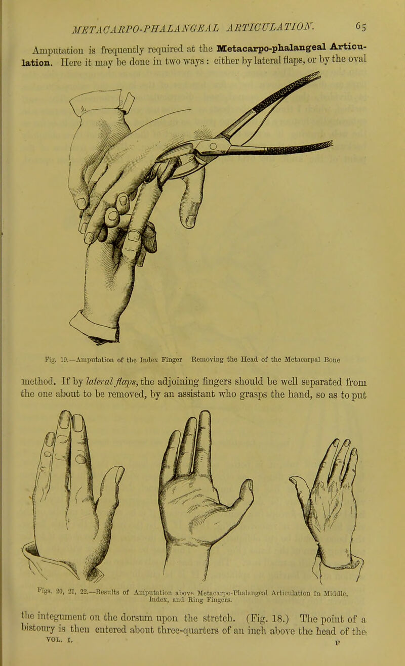 Amputation is frequently required at the Metacarpo-plialangeal Articu- lation. Here it may be done in two ways : either by lateral flaps, or by the oval I'ig. 19.—Araputation of tlie Imlex Finger Removing the Head of the Metacarpal Bone method. If by lateral fla'ps, the adjoining fingers should be well separated from the one about to be removed, by an assistant who gvasps the hand, so as to put I'iga. 20, 21, 22.—Results of Amputation aliove J[etncari)0-Phalangeal Articulation in Middle, Index, and Ring Fingers. the integument on the dorsum upon the stretch. (Fig. 18.) The point of a bistoury is then entered about three-quarters of an inch abo-i-c the head of thO'