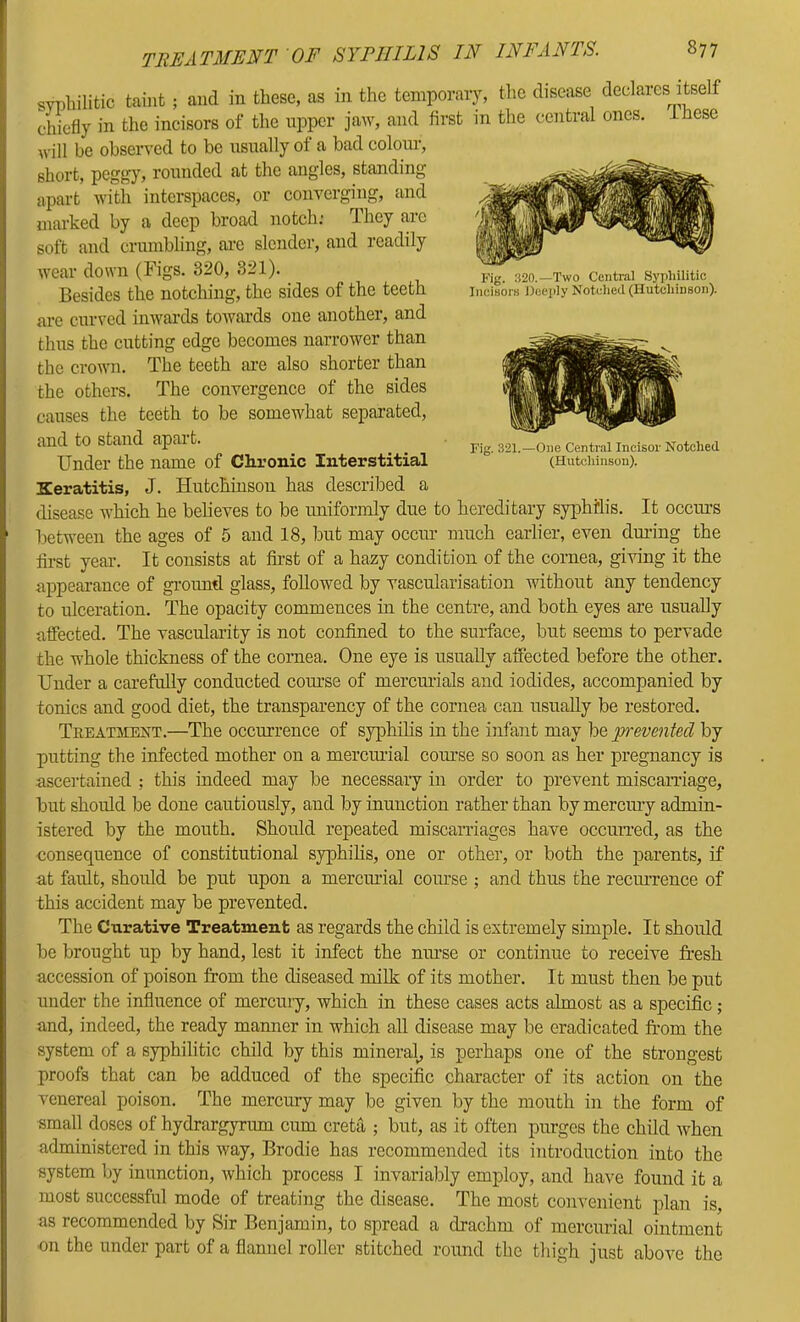 Fig. 320.—Two Central Syphilitic Incisors Deeply Notched (Hutchinson). Fig. 321.—One Central Incisor Notched (Hutchinson). treatment of syphilis in infants SYpbilitic taint ; and in these, as in the temporary, the disease declares itself chiefly in the incisors of the upper jaw, and first in the central ones, ihese will be observed to be usually of a bad colom-, short, pegg}', rounded at the angles, standing apart with interspaces, or converging, and marked by a deep broad notch; They arc soft and crumbling, ai’c slender, and readily wear down (Figs. 820, 321). Besides the notching, the sides of the teeth are curved inwards towards one another, and thus the cutting edge becomes narrower than the crown. The teeth are also shorter than the others. The convergence of the sides causes the teeth to be somewhat separated, and to stand apart. Under the name of Chronic Interstitial Keratitis, J. Hutchinson has described a disease which he believes to be uniformly due to hereditary syphilis. It occui’s between the ages of 5 and 18, but may occim much earlier, even dm-ing the first year. It consists at first of a hazy condition of the cornea, giving it the appearance of gi’ound glass, followed by vascularisation without any tendency to ulceration. The opacity commences in the centre, and both eyes are usually affected. The vascularity is not confined to the surface, but seems to pervade the whole thickness of the cornea. One eye is usually affected before the other. Under a carefully conducted com’se of mercmials and iodides, accompanied by tonics and good diet, the transparency of the cornea can usually be restored. Treatment.—The occurrence of syphilis in the infant may be p-eventecl by putting the infected mother on a mercimial com'se so soon as her pregnancy is ascei-tained ; this indeed may be necessary in order to prevent miscarriage, but should be done cautiously, and by inunction rather than by mercury admin- istered by the mouth. Should repeated miscarriages have occurred, as the consecpience of constitutional syphilis, one or other, or both the parents, if at fault, should be put upon a mercmial course ; and thus the reciu-rence of this accident may be prevented. The Curative Treatment as regards the child is extremely simple. It should be brought up by hand, lest it infect the niu’se or continue to receive fresh accession of poison from the diseased milk of its mother. It must then be pnt under the influence of mercury, which in these cases acts almost as a specific; and, indeed, the ready manner in which all disease may be eradicated from the system of a syphilitic child by this mineral, is perhaps one of the strongest proofs that can be adduced of the specific character of its action on the venereal poison. The mercury may be given by the mouth in the form of small doses of hydrargyrum cum creta ; but, as it often purges the child when administered in this way, Brodie has recommended its introduction into the system by inunction, which process I invariably employ, and have found it a most successful mode of treating the disease. The most convenient plan is, as recommended by Sir Benjamin, to spread a drachm of mercurial ointment on the under part of a flannel roller stitched round the thigh just above the