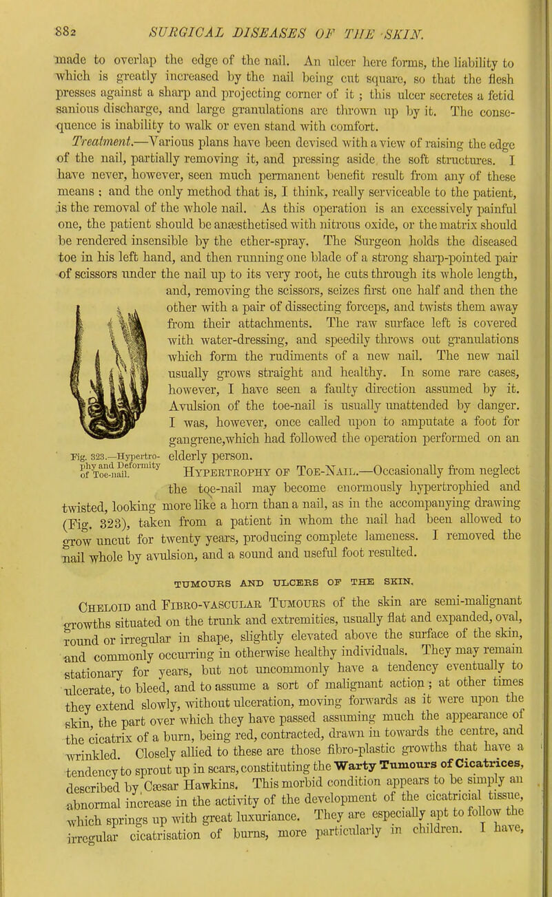 made to overlap the edge of the nail. An nicer here forms, the liability to which is greatly increased by the nail being cut sejuare, so that the flesh presses against a sharp and projecting corner of it; this ulcer secretes a fetid sanious discharge, and large granulations are thrown up by it. The conse- quence is inability to walk or even stand with comfort. Treatment.—Various plans have been devised with a view of raising the edge of the nail, partially removing it, and pressing aside the soft structures. I have never, however, seen much pennanent benefit result from any of these means ; and the only method that is, I think, really serviceable to the patient, is the removal of the whole nail. As this operation is an excessively painful one, the patient should be anassthetised with nitrous oxide, or the matrix should be rendered insensible by the ether-spray. The Surgeon holds the diseased toe in his left hand, and then running one blade of a strong shaip-pointed pair of scissors under the nail up to its very root, he cuts through its whole length, and, removing the scissors, seizes first one half and then the I V other mth a pair of dissecting forceps, and twists them away I fitt^'Chments. The raw surface left is covered f i water-dressing, and speedily throws out granulations f i k 'which form the rudiments of a new nail. The new nail m I sVil usually grows straight and healthy. In some rare cases, % however, I have seen a faulty direction assumed by it. f Avulsion of the toe-nail is usually imattended by danger. I was, however, once called upon to amputate a foot for gaugi-ene,which had followed the operation performed on an rig. 323.—Hypertro- elderly person. of Hypertrophy op Toe-Nail.—Occasionally from neglect the tqe-nail may become enormously hypertrophied and twisted, looking more like a horn than a nail, as in the accompanying drawing (Fig. 323), taken from a patient in whom the nail had been allowed to oTow uncut for twenty years, producing complete lameness. I removed the nail whole by axudsion, and a sound and useful foot resulted. TUMOURS AND ULCERS OP THE SKIN, Cheloid and Fibro-vascular Tumours of the skin are semi-mahgnant oTowths situated on the trunk and extremities, usually flat and expanded, oval, round or irregular in shape, slightly elevated above the surface of the skin, and commonly occun’ing in otheiwise healthy individuals. They may remain stationary for years, but not imcommonly have a tendency eventually to ulcerate, to bleed, and to assume a sort of mahgnant action ; at other times they extend slowly, without ulceration, moving forwards as it were upon the skin the part over which they have passed assuming much the appearance of the cicatrix of a burn, being red, contracted, drawn in towai'ds the centre, and Avrinkled. Closely alhed to these are those fibro-plastic growths that have a tendency to sprout up in scars, constituting the Warty Tumours of Cicatrices, described by Cmsar Hawkins. This morbid condition appears to be simply an abnormal increase in the activity of the development of the cicatricial tissue, which springs up udth great luxmiance. They are especiaUy apt to ^llow the irre<^ular cicatrisation of bums, more particularly in children. I have,