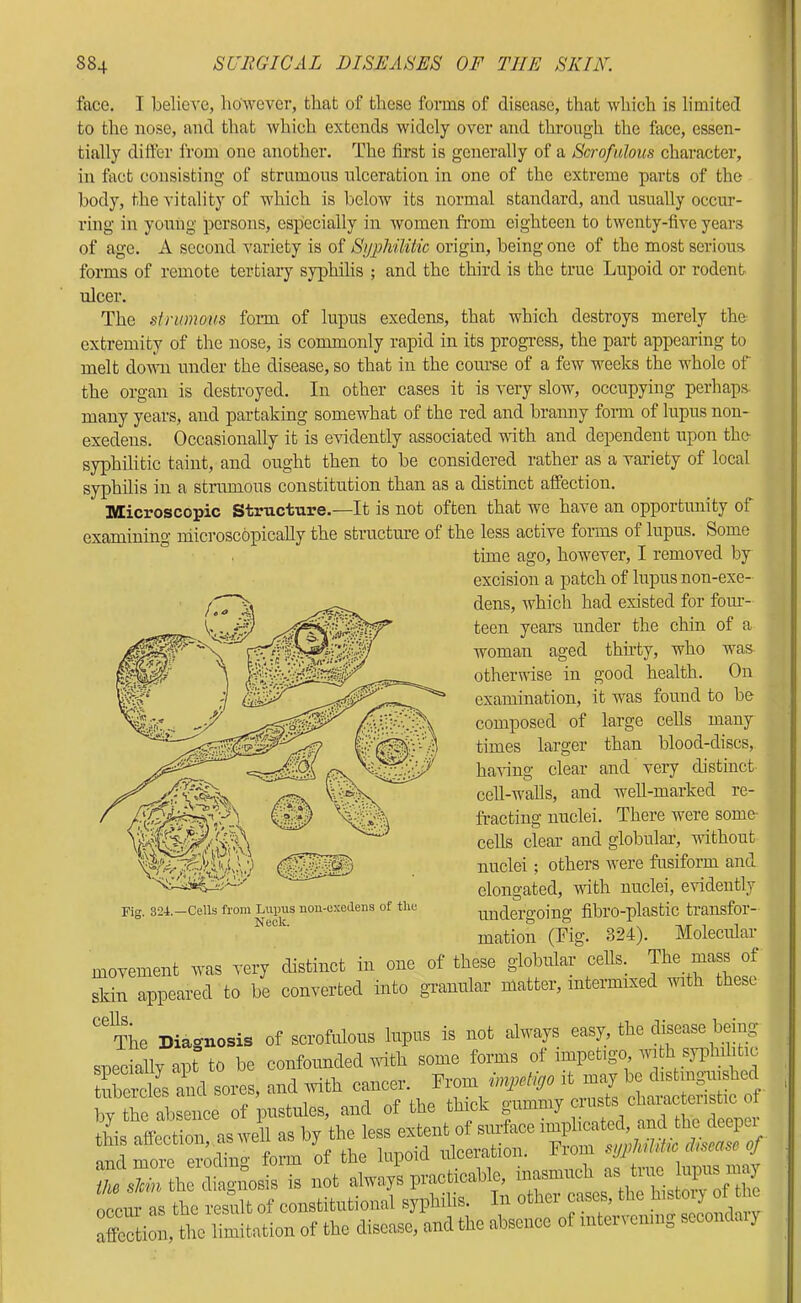 face, I believe, however, that of these forms of disease, that which is limited to the nose, and that which extends widely over and through the face, essen- tially differ from one another. The first is generally of a Scrofulous character, in fact consisting of strumous ulceration in one of the extreme parts of the body, the vitality of which is below its normal standard, and usually occur- ring in young persons, especially in women from eighteen to twenty-five years of age, A second variety is of SyjphUitic origin, being one of the most serious forms of remote tertiary syphilis ; and the third is the true Lupoid or rodent ulcer. The strumous form of lupus exedens, that which destroys merely the- extremity of the nose, is commonly rapid in its progress, the part appearing to melt dovm under the disease, so that in the course of a few weeks the whole of the organ is destroyed. In other cases it is very slow, occupying perhaps many years, and partaking somewhat of the red and branny form of lupus non- exedens. Occasionally it is evidently associated with and dependent upon the- syphilitic taint, and ought then to be considered rather as a variety of local syphilis in a strumous constitution than as a distinct affection. Microscopic Structure.—It is not often that we have an opportunity of examining niicroscopically the structure of the less active forms of lupus. Some time ago, however, I removed by excision a patch of lupus non-exe- dens, which had existed for four- teen years under the chin of a woman aged thu’ty, who was otherwise in good health. On examination, it was found to be composed of large cells many times larger than blood-discs, ha'S’ing clear and very distinct cell-walls, and weU-marked re- fracting nuclei. There were some- cells clear and globular, without nuclei; others Avere fusiform and elongated, with nuclei, evidently undergoing fibro-plastic transfor- mation (Fig. 324). Molecular movement was very distinct in one of these globular cells. The mass of skin appeared to be converted into granular matter, intermixed with these “The Biagnoeis of scrofulous lupus is not always easy, the aisease beiug SBedolly apt to be confounded wdth some forms of impetigo, wi A syphilitic ESs and sores, and ivith cancer. From it may be distmi^ished hi the abJence of pustules, and of the thick gummy crusts obaiim eristic of this affietioii, as well as by the less 'Si“ X aSL iba^^osis is not always practicable, irti rLmrS OCCIU’ as the result of constitutional syphilis, u o ’ j secondary affection, the limitation of the disease, and the absence of mteuenin, secoudaiy Fiir 324.—Cells from Lupus non-uxedens of tlio Neck.