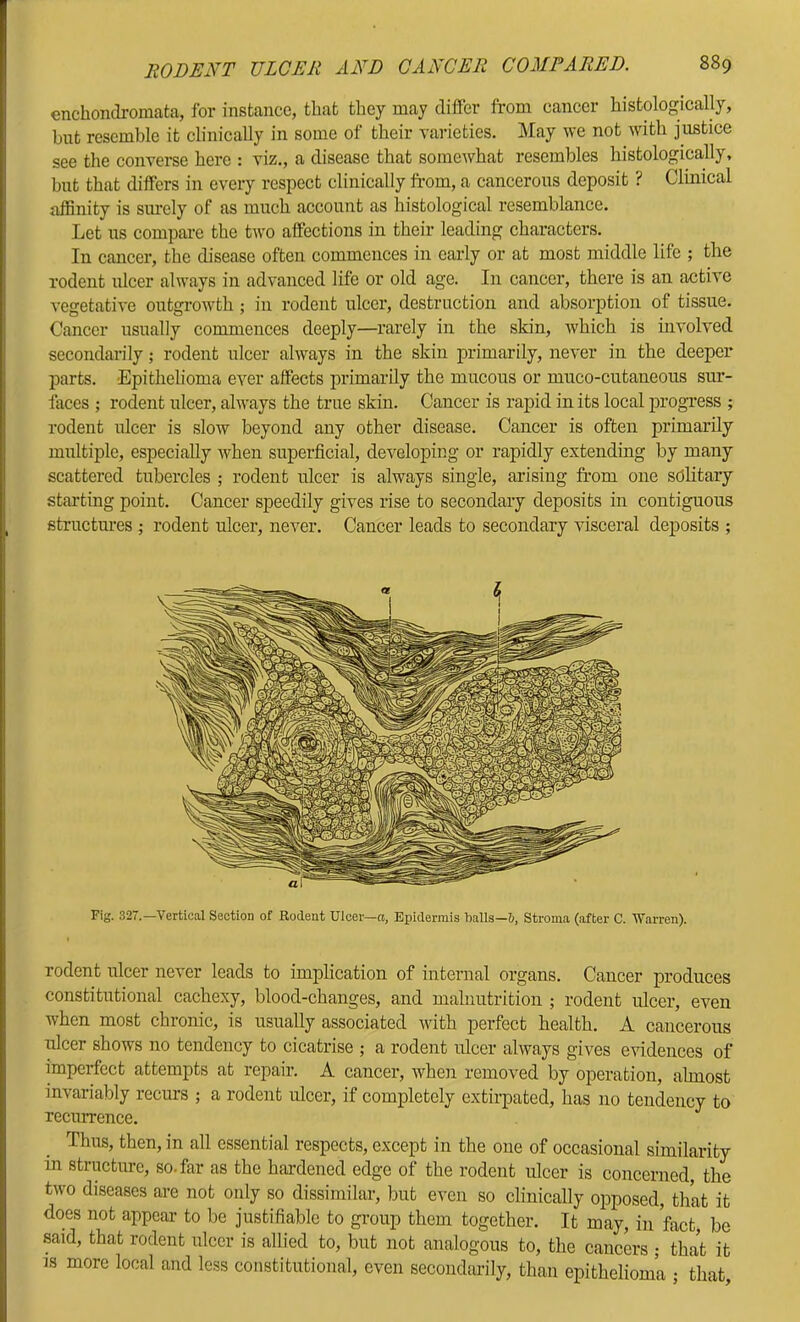 enchonclromata, for instance, that they may differ from cancer histologically, but resemble it clinically in some of their varieties. May we not with justice see the converse here : viz., a disease that somewhat resembles histologically, but that differs in every respect clinically from, a cancerous deposit ? Clinical affinity is sm’ely of as much account as histological resemblance. Let us compare the two affections in their leading characters. In cancer, the disease often commences in early or at most middle life ; the rodent ulcer always in advanced life or old age. In cancer, there is an active vegetative outgrowth ; in rodent ulcer, destruction and absorption of tissue. Cancer usually commences deeply—rarely in the skin, which is involved secondarily; rodent ulcer always in the skin primarily, never in the deeper parts. -Epithelioma ever affects primarily the mucous or muco-cutaneous sur- iaces ; rodent ulcer, always the true skin. Cancer is rapid in its local progress ; rodent ulcer is slow beyond any other disease. Cancer is often primarily multiple, especially when superficial, developing or rapidly extending by many scattered tubercles ; rodent nicer is always single, arising from one solitary starting point. Cancer speedily gives rise to secondary deposits in contiguous structures ; rodent ulcer, never. Cancer leads to secondary visceral deposits ; Fig. 327.—Vertical Section of Rodent Ulcer—a, Epidermis halls—6, Stroma (after C. Warren). rodent ulcer never leads to implication of internal organs. Cancer produces constitutional cachexy, blood-changes, and malnutrition ; rodent ulcer, even when most chronic, is usually associated with perfect health. A cancerous ulcer shows no tendency to cicatrise ; a rodent ulcer always gives evidences of imperfect attempts at repair. A cancer, when removed by operation, almost invariably recurs ; a rodent ulcer, if completely extirpated, has no tendency to recurrence. Thus, then, in all essential respects, except in the one of occasional similarity in structure, so. far as the hardened edge of the rodent ulcer is concerned, the two diseases are not only so dissimilar, but even so clinically opposed, that it does not appear to be justifiable to group them together. It may, in fact, be said, that rodent ulcer is allied to, but not analogous to, the cancers ; that it IS more local and less constitutional, even secondarily, than epithelioma ; that,