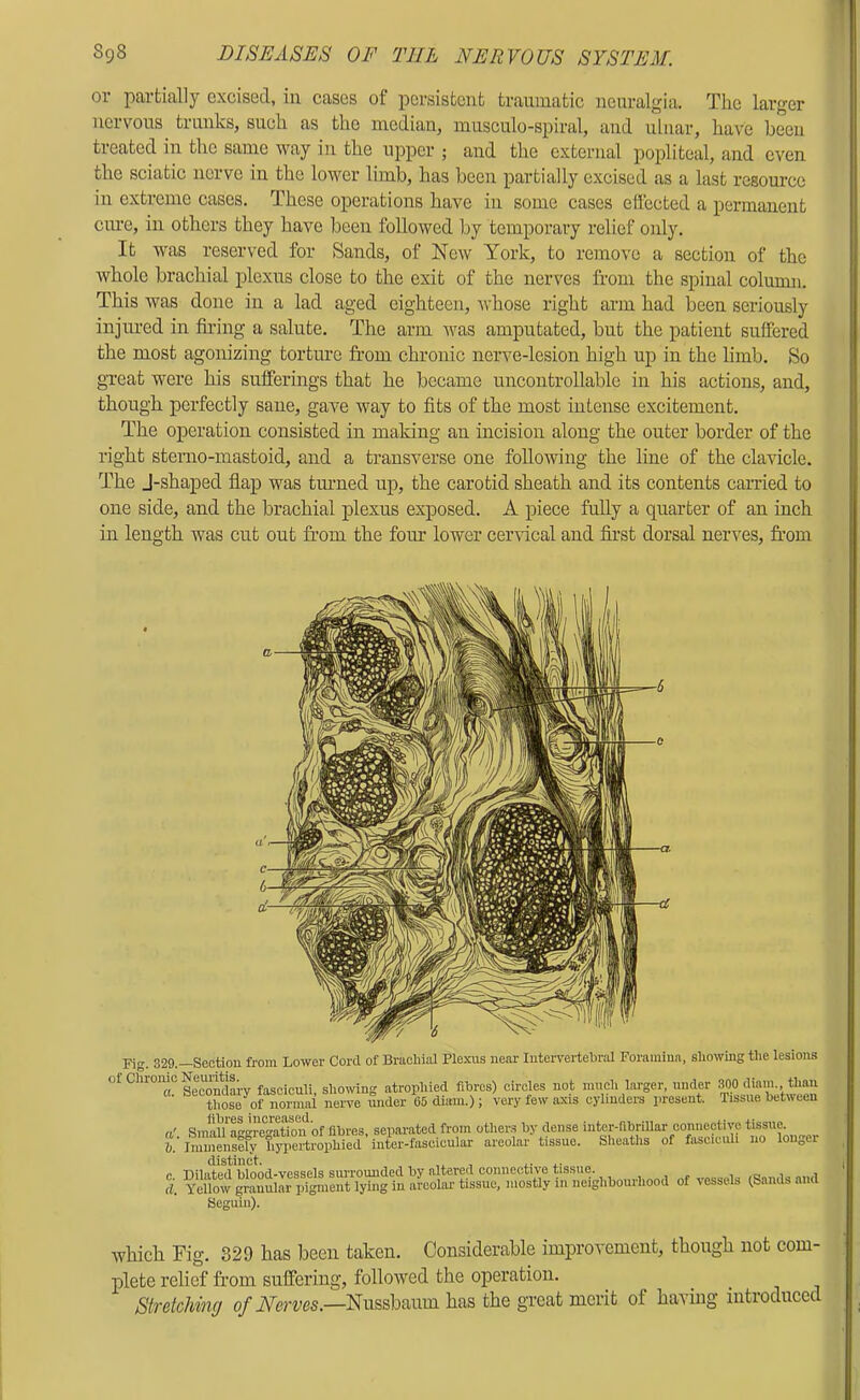 or partially excised, iir eases of persistent traumatic neuralgia. The larger nervous trunks, such as the median, musculo-spiral, and ulnar, have been tieated in the same way in the upper ; aud the external popliteal, and even the sciatic nerve in the lower limb, has been partially excised as a last resource in extreme cases. These operations have in some cases effected a permanent cure, in others they have been followed by temporary I’elief only. It was reserved for Sands, of New York, to remove a section of the whole brachial plexus close to the exit of the nerves from the spinal column. This was done in a lad aged eighteen, whose right arm had been seriously injured in firing a salute. The arm was amputated, but the patieut suffered the most agonizing torture from chronic nerve-lesion high up iu the limb. So great were his sufferings that he became uncontrollable in his actions, and, though perfectly sane, gave way to fits of the most intense excitement. The operation consisted in making an incision along the outer border of the right stenio-niastoid, and a transverse one following the line of the clavicle. The J-shaped flap was tinned up, the carotid sheath and its contents carried to one side, and the brachial plexus exposed. A piece fully a quarter of an inch in length was cut out from the four lower cenical and first dorsal nerves, fr’om Fig. 329.—Section from Lower Cord of Brachial Plexus near Intervertebral Foramina, showing the lesioris which Fig. 329 has been taken. Considerable improvement, though not com- plete relief from suffering, followed the operation. Stretching of Nerves.—Nussbaum has the great merit of haviug introduced Seguin).