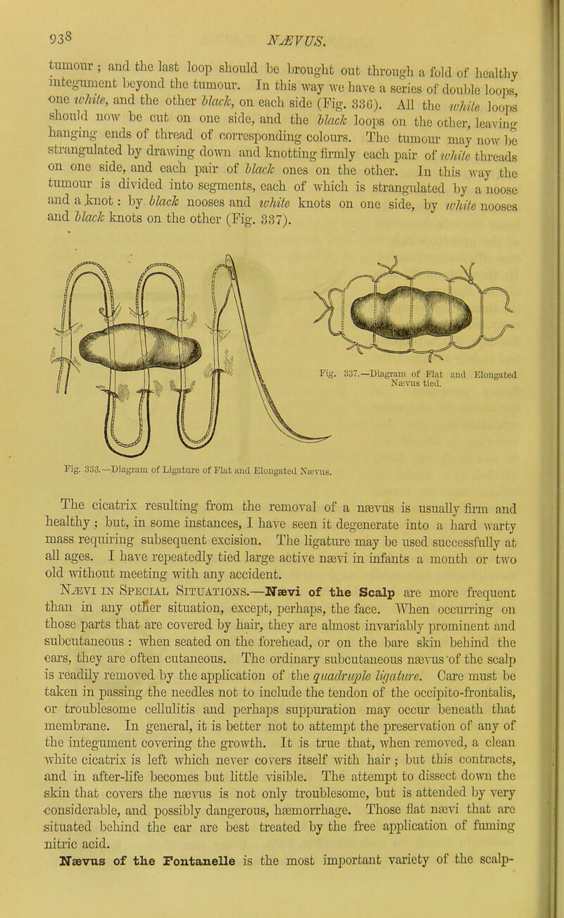 tumour; and the last loop should be brought out through a fold of healthy mtcgimmnt beyond the tumour. In this way we have a series of douljle loops, one toMe, and the other hlach, on each side (Fig. 38G). All the while looi)S should now be cut on one side, and the Uaclc loops on the other, leaving hanging ends of thread of corresponding colours. The tumoiu’ may now be strangulated by drawing down and knotting firmly each pair of ivhile threjids on one side, and each pair of Ucwlc ones on the other. In this way the tumour is divided into segments, each of which is strangulated by a noose and a hnot: by blade nooses and ivhite knots on one side, by while nooses and blade knots on the other (Fig. 337). Fig. 333.—Diagram of Ligature of Flat and Elougateil Nie-vus. The cicatrix resulting from the removal of a ntevus is usually firm and healthy ; but, in some instances, I have seen it degenerate into a hard warty mass requiring subsequent excision. The hgatiu’e may be used successfully at all ages. I have repeatedly tied large active ntevi in infants a month or two old without meeting with any accident. N^vi i]sr Special Situations.—Ifaevi of the Scalp are more frequenc than in any otEer situation, excejit, perhaps, the face. When occurring on those parts that are covered by hair, they are almost invariably prominent and subcutaneous : when seated on the forehead, or on the bare skin behmd the eai’s, they are often cutaneous. The ordinary subcutaneous meiTis ‘of the scalp is readily removed by the ajiphcation of the quadruple ligature. Care must be taken in passing the needles not to include the tendon of the occipito-frontalis, or troublesome cellulitis and perhaps suppuration may occim beneath that membrane. In general, it is better not to attempt the preservation of any of the integument covering the growth. It is true that, when removed, a clean white cicatrix is left which ne'^'er covers itself with hair; but this contracts, and in after-life becomes but little visible. The attempt to dissect down the skin that covers the naivus is not only troublesome, but is attended by very considerable, and possibly dangerous, hEemorrhage. Those flat naivi that are situated behind the ear are b^est treated by the free application of fuming nitric acid. Naevus of the Fontanelle is the most important variety of the scalp-