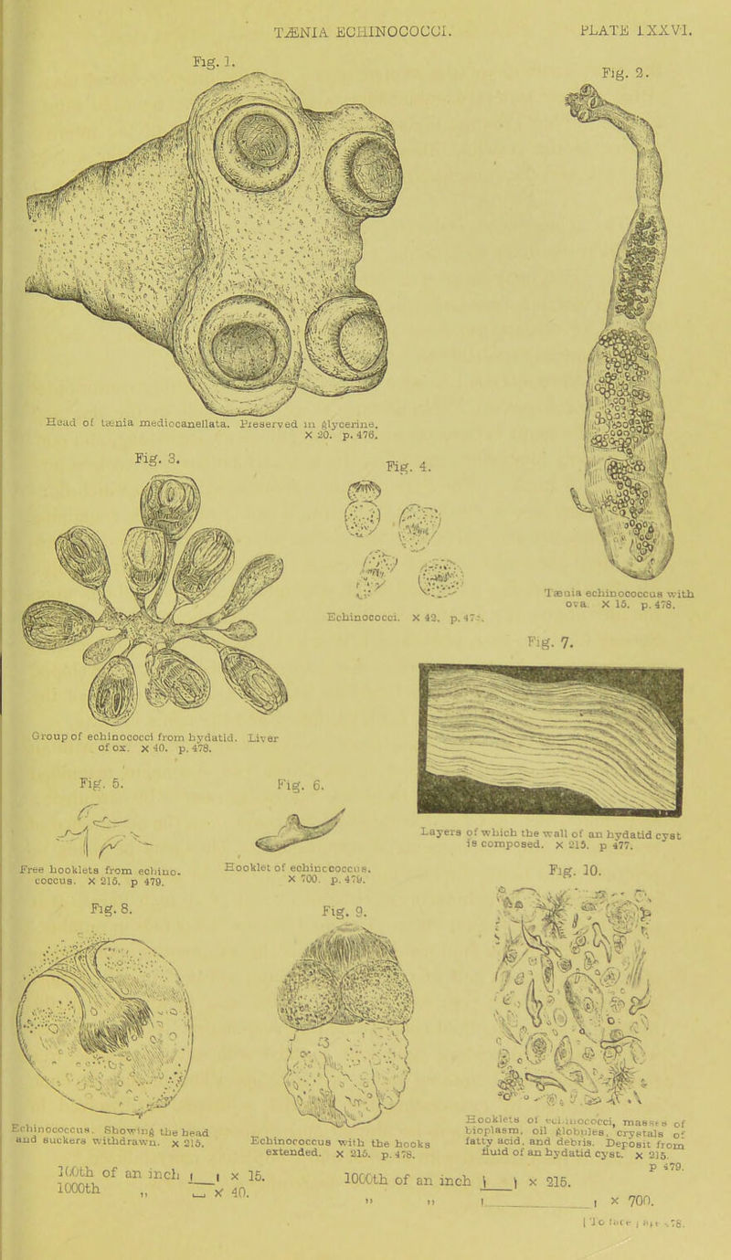 Fig. 2. Group of echinococci from hydatid. Liver of ox. x -10. p. 478. Fig. 3. Taenia echinococcus with ova X 15. p.478. Fig. 7. Fig. 5. I Head of taenia mediocanellata. Preserved m glycerine. X 20. p. 476. Fig. 4. n' /*v-r.v Echinococci. X 42. p. <37?. Layers of which the wall of an hydatid cyst is composed, x 215. p 477. Free booklets from echino- coccus. X 215. p 479. Fig. 8. Echinococcus. Showing the head and suckers withdrawn, x 216. IGOth of an inch i i000th Hooklet of echinccoccus. X 700. p. 479. Fig. 9. Echinococcus with the hooks extended, x 215. p. 478. .> x 15. 1000th of an i: x 40. t> n Fig. 10. Booklets oi echinococci, masses of bioplasm, oil (Slobules. crystals or fatty acid; and debiis. Deposit from fluid of an hydatid cyst, x 215. p 479. h j \ X 215. I X 700.