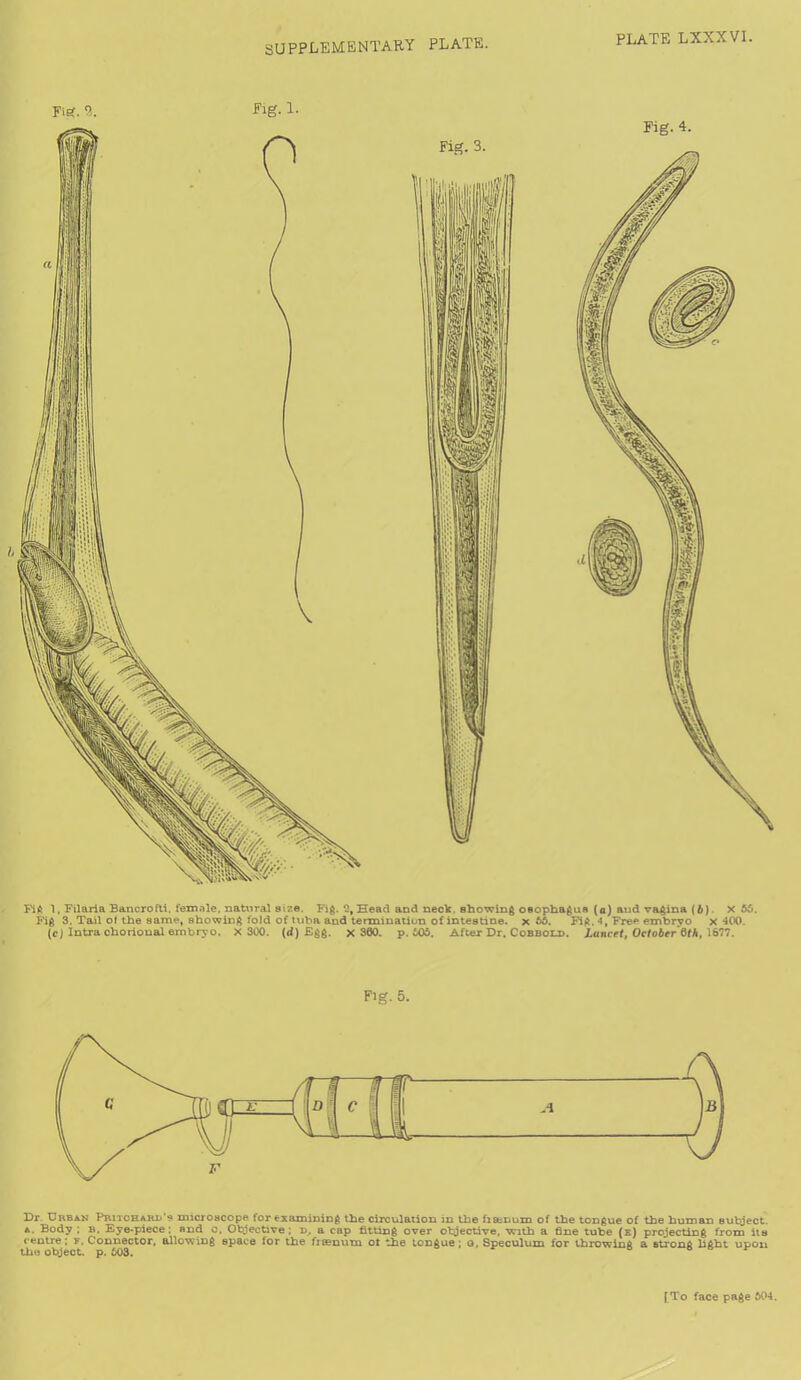 SUPPLEMENTARY PLATE. Fig. 4. Fig 1, Filaria Bancrofli. female, natural size. Fig. 0, Head and neck showing osophagus (a) and vagina (b) X 50. Fig 3. Tail of the same, showing fold of tuba and termination of intestine, x 55. Fig. 4, Free embryo x 400. (cj Intra chorional embryo. X 300. (d) Egg. x 360. p. 605. After Dr. Cobbold. Lancet, October 6th, 1677. F'g. 5. Dr. Urban Pritchard's microscope for examining the circulation in the fisenum of the tongue of the human subject. a. Body ; b. Eye-piece; nnd c. Objective; d. a cap fitting over objective, with a fine tube (e) projecting from its centre; f. Connector, allowing space for the fitenum ot the tongue; o. Speculum for throwing a strong light upon the object, p. 603.