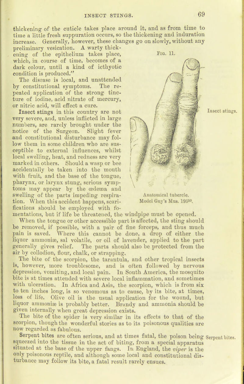 INSECT STINGS. thicliening of the cuticle takes place around it, and as from time to time a little fresh suppuration occurs, so the thickening and induration increase. Generally, however, these changes go on slowly, without any preliminary vesication. A warty thick- ening of the epithelium takes place, which, in course of time, becomes of a dark colour, until a kind of icthyotic condition is produced.” The disease is local, and unattended by constitutional symptoms. Tlie re- peated application of the strong tinc- ture of iodine, acid nitrate of mercury, or nitric acid, will effect a cure. Insect stings in this conntry are not very severe, and, unless inflicted in large numbers, are rarely brought under the notice of the Surgeon. Slight fever and constitutional distui'bance may fol- low them in some children who are sus- ceptible to external influences, whilst local swelling, heat, and redness are very marked in others. Should a wasp or bee accidentally be taken into the mouth with fruit, and the base of the tongue, pharynx, or larynx stung, serious symp- toms may appear by the oedema and swelling of the parts impeding respira- tion. When this accident happens, scari- fications should be employed with fo- mentations, but if life be threatened, the windpipe must be opened. When the tongue or other accessible part is afl’ected, the sting should be removed, if possible, with a pair of fine forceps, and thus much pain is saved. AVhei’e this cannot be done, a drop of either the liquor ammoniaj, sal volatile, or oil of lavender, applied to the part generally gives relief. The parts should also be protected from the air by collodion, flour, chalk, or strapping. The bite of the scorpion, the tarantula, and other tropical insects is, however, more troublesome, and is often followed by nervous depression, vomiting, and local pain. In South America, the mosquito bite is at times attended with severe local inflammation, and sometimes with ulceration. In Africa and Asia, the scorpion, which is from six to ten inches long, is so venomous as to cause, by its bite, at times, loss of life. Olive oil is the usual application for the wound, but liquor ammonia} is probably better. Brandy and ammonia should be given internally when great depression exists. The bite of the spider is very similar in its effects to that of the scorpion, though the wonderful stories as to its poisonous qualities are now regarded as fabulous. Serpent bites are often serious, and at times fatal, the poison being squeezed into the tissue in the act of biting, from a special apparatus situated at the base of the upper fangs. In England, the vvper is the only poisonous reptile, and although some local and constitutional dis- turbance may follow its bite, a fatal result rarely ensues. Fig. 11. Anntoiuical tubercle. Model Guy’s Mus. 193“. Insect stings. Serpent bites.