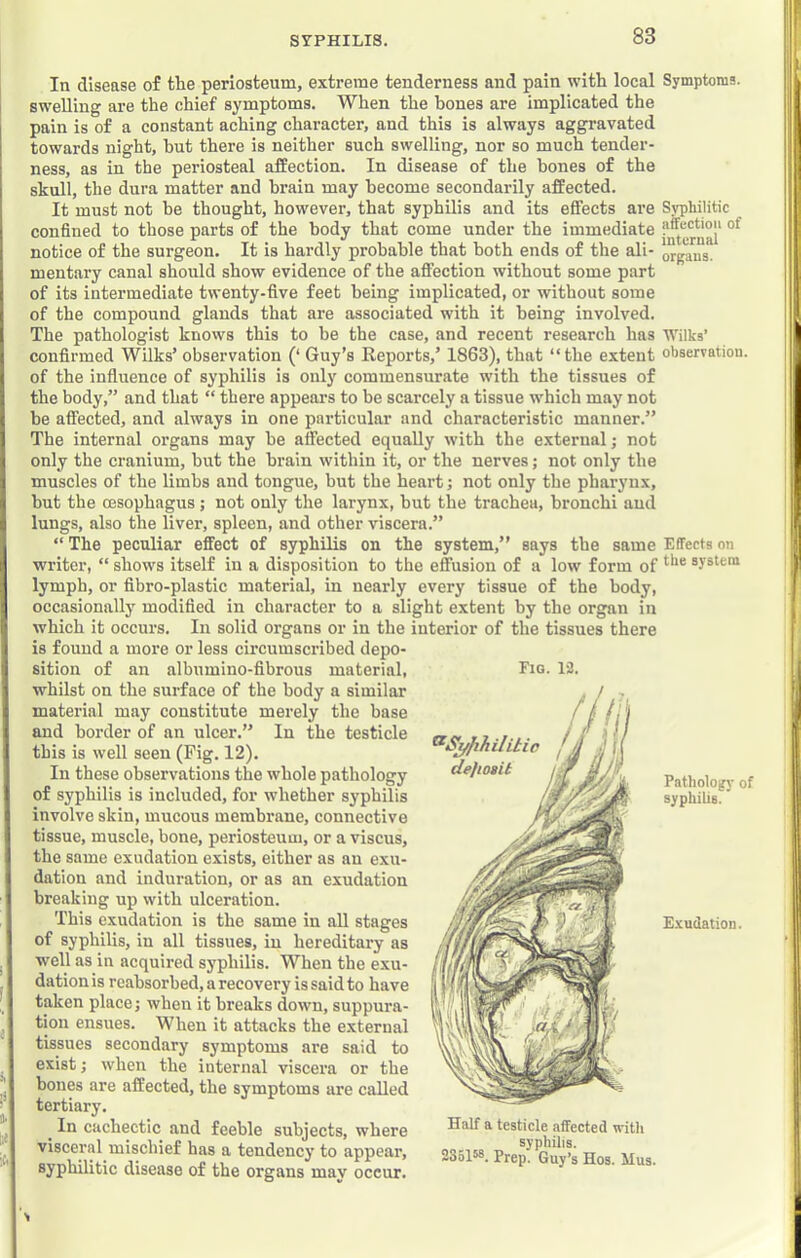 In disease of the periosteum, extreme tenderness and pain with local Symptoms, swelling are the chief symptoms. When the hones are implicated the pain is of a constant aching character, and this is always aggravated towards night, hut there is neither such swelling, nor so much tender- ness, as in the periosteal affection. In disease of the bones of the skull, the dura matter and brain may become secondarily affected. It must not be thought, however, that syphilis and its effects are Syphilitic confined to those parts of the body that come under the immediate notice of the surgeon. It is hardly probable that both ends of the ali- organs, mentary canal should show evidence of the affection without some part of its intermediate twenty-five feet being implicated, or without some of the compound glands that are associated with it being involved. The pathologist knovvs this to be the case, and recent research has Wilks’ confirmed Wilks’ observation (‘ Guy’s Eeports,’ 1863), that “the extent observation, of the influence of syphilis is only commensurate with the tissues of the body,” and that “ there appears to be scarcely a tissue which may not be affected, and always in one particular and characteristic manner.” The internal organs may he affected equally with the external; not only the cranium, but the brain within it, or the nerves; not only the muscles of the limbs and tongue, but the heart; not only the pharynx, hut the oesophagus; not only the larynx, but the trachea, bronchi and lungs, also the liver, spleen, and other viscera.” “ The peculiar effect of syphilis on the system,” says the same Effects on writer, “ shows itself in a disposition to the effusion of a low form of system lymph, or fibro-plastic material, in nearly every tissue of the body, occasionally modified in character to a slight extent by the organ in which it occurs. In solid organs or in the interior of the tissues there is found a more or less circumscribed depo- sition of an albumino-fibrous material, whilst on the surface of the body a similar material may constitute merely the base and border of an ulcer.” In the testicle this is well seen (Fig. 12). In these observations the whole pathology of syphilis is included, for whether syphilis involve skin, mncous membrane, connective tissue, muscle, bone, periosteum, or a viscus, the same exudation exists, either as an exu- dation and induration, or as an exudation breaking up with ulceration. This exudation is the same in all stages of syphilis, in all tissues, in hereditary as well as in acquired syphilis. When the exu- dation is reabsorbed, a recovery is said to have taken place; when it breaks down, suppura- tion ensues. When it attacks the external tissues secondary symptoms are said to exist; when the internal viscera or the bones are affected, the symptoms are called tertiary. ^ In cachectic and feeble subjects, where visceral mischief has a tendency to appear, syphilitic disease of the organs may occur. Fig. 13. ^S^fihihtic de]ioBit Patholo|fj' of syphilis. ’ E-vudation. Half a testicle affected with syphilis. 235158. Prep. Guy’s Hos. Mus.