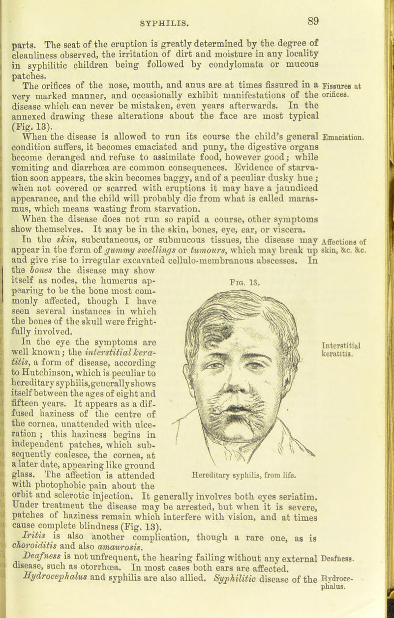 parts. The seat of the eruption is greatly determined by the degree of cleanliness observed, the irritation of dirt and moisture in any locality in syphilitic children being followed by condylomata or mucous patches. The orifices of the nose, mouth, and anus are at times fissured in a Fisanres at very marked manner, and occasionally exhibit manifestations of the orifices, disease which can never be mistaken, even years afterwards. In the annexed drawing these alterations about the face are most typical (Fig. 13). When the disease is allowed to run its course the child’s general Emaciation, condition suflFers, it becomes emaciated and puny, the digestive organs become deranged and refuse to assimilate food, however good; while vomiting and diarrhoea are common consequences. Evidence of starva- tion soon appears, the skin becomes baggy, and of a peculiar dusky hue j when not covered or scarred with eruptions it may have a jaundiced appearance, and the child will probably die from what is called maras- mus, which means wasting from starvation. When the disease does not run so rapid a course, other symptoms show themselves. It may be in the skin, bones, eye, ear, or viscera. In the skin, subcutaneous, or submucous tissues, the disease may Affections of appear in the form of gummy swellings or tumours, which may break up skin, Jfec. 8cc. and give rise to irregular excavated cellulo-membranous abscesses. In the bones the disease may show itself as nodes, the humerus ap- pearing to be the bone most com- monly affected, though I have seen several instances in which the bones of the skull were fright- fully involved. In the eye the symptoms are well known; the interstitial kera- titis, a form of disease, according to Hutchinson, which is peculiar to hereditary syphilis,generally shows itself between the ages of eight and fifteen years. It appears as a dif- fused haziness of the centre of the cornea, unattended with ulce- ration ; this haziness begins in independent patches, which sub- sequently coalesce, the cornea, at a later date, appearing like ground glass. The affection is attended with photophobic pain about the orbit and sclerotic injection. It generally involves both ej’es seriatim. Under treatment the disease may be arrested, but when it is severe, patches of haziness remain which interfere with vision, and at times cause complete blindness (Fig. 13). Iritis is also another complication, though a rare one, as is choroiditis and also amaurosis. Deafness is not unfrequent, the hearing failing without any external Deafness, disease, such as otorrhoea. In most cases both ears are affected. Hydrocephalus and syphilis are also allied. Syphilitic disease of the Hydroce- phalus. Em. 13. Interstitial keratitis.