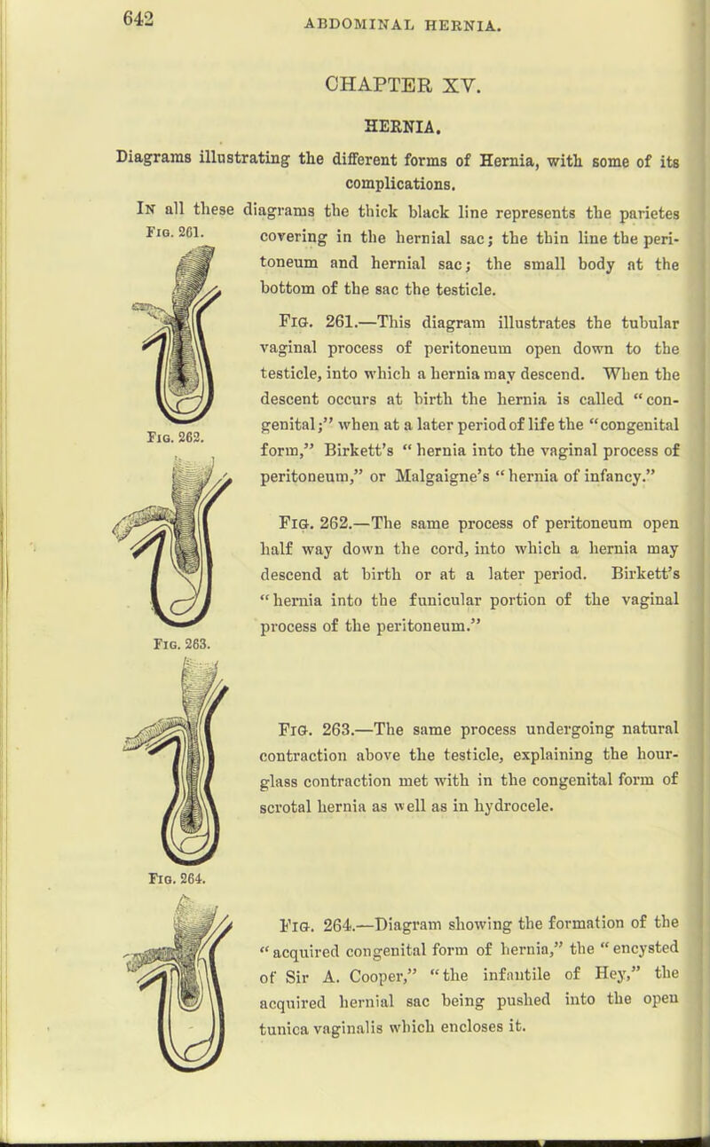 CHAPTER XV. HERNIA. Fig. 2C1. Fig. 262. Diagrams illustrating the different forms of Hernia, with some of its complications. In all these diagrams the thick black line represents the parietes covering in the hernial saej the thin line the peri- toneum and hernial sac; the small body at the bottom of the sac the testicle. Fig. 261.—This diagram illustrates the tubular vaginal process of peritoneum open down to the testicle, into which a hernia may descend. When the descent occurs at birth the hernia is called “con- genital when at a later period of life the “congenital form,” Birkett’s “ hernia into the vaginal process of peritoneum,” or Malgaigne’s “hernia of infancy.” Fig. 262.—The same process of peritoneum open half way down the cord, into which a hernia may descend at birth or at a later period. Birkett’s “hernia into the funicular portion of the vaginal process of the peritoneum.” Fig. 263.—The same process undergoing natural contraction above the testicle, explaining the hour- glass contraction met with in the congenital form of scrotal hernia as well as in hydrocele. Fig. 264.—Diagram showing the formation of the “acquired congenital form of hernia,” the “encysted of Sir A. Cooper,” “the infantile of Hey,” the acquired hernial sac being pushed into the open tunica vaginalis which encloses it.