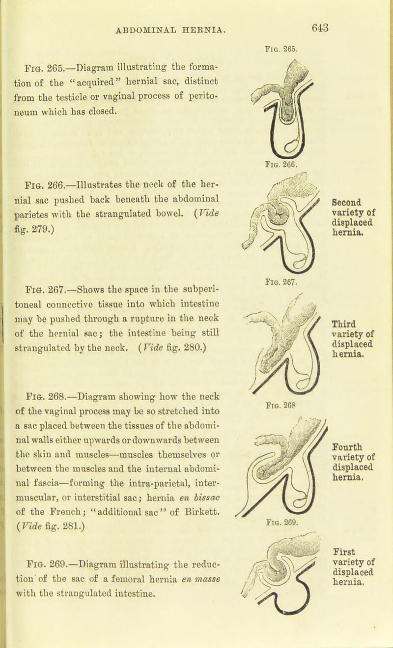 Fig. 265.—Diagram illustrating the forma- tion of the “acquired” hernial sac, distinct from the testicle or vaginal process of perito- neum which has closed. Fig. 266.—Illustrates the neck of the her- nial sac pushed back beneath the abdominal parietes with the strangulated bowel. {Vide fig. 279.) Fig. 267.—Shows the space in the subperi- toneal connective tissue into which intestine may he pushed through a rupture in the neck of the hernial sacj the intestine being still strangulated by the neck. (Vide fig. 280.) Fig. 268.—Diagram showing how the neck of the vaginal process may be so stretched into a sac placed between the tissues of the abdomi- nal walls either upwards or downwards between the skin and muscles—muscles themselves or between the muscles and the internal abdomi- nal fascia—forming the intra-parietal, inter- muscular, or interstitial sac; hernia en bissac of the French; “additional sac” of Birkett. {Vide fig. 281.) Fig. 269.—Diagram illustrating the reduc- tion of the sac of a femoral hernia en masse with the strangulated intestine. Tig. 265. Fig. 267. Second variety of displaced hernia. Third variety of displaced hernia. Fourth variety of displaced hernia. First variety of displaced hernia.