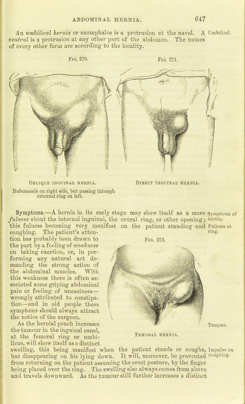 An umbilical hernia or exomphalos is a protrusion at the navel. A Umbilical, f ventral is a protrusion at any other part of the abdomen. The names 1 of every other form are according to the locality. Eig. 370. Fig. 271. Oblique inguinal heknia. Bubonocele on right side, but passing through external ring on left. Direct inguinal rernia. Symptoms.—A hernia in its early stage may show itself as a mere Symptoms of fulness about the internal inguinal, the crural ring, or other opening; hernia, this fulness becoming very manifest on the patient standing and Fulness at coughing. The patient’s atten- ■'ing. tion has probably been drawn to Fig. 272. the part by a feeling of weakness on taking exertion, or, in per- forming any natural act de- manding the strong action of the abdominal muscles. With this weakness there is often as- sociated some griping abdominal pain or feeling of uneasiness— wrongly attributed to constipa- tion—and in old people these symptoms should always attract the notice of the surgeon. As the hernial pouch increases Tumour, the tumour in the inguinal canal, at the femoral ring or umbi- licus, will show itself as a distinct swelling, this being manifest when the patient stands or coughs. Impulse on but disappearing on his lying down. It will, moreover, he prevented coughing, from returning on the patient assuming the erect posture, by the finger being placed over the ring. The swelling also always comes from above and travels downward. As the tumour still further increases a distinct